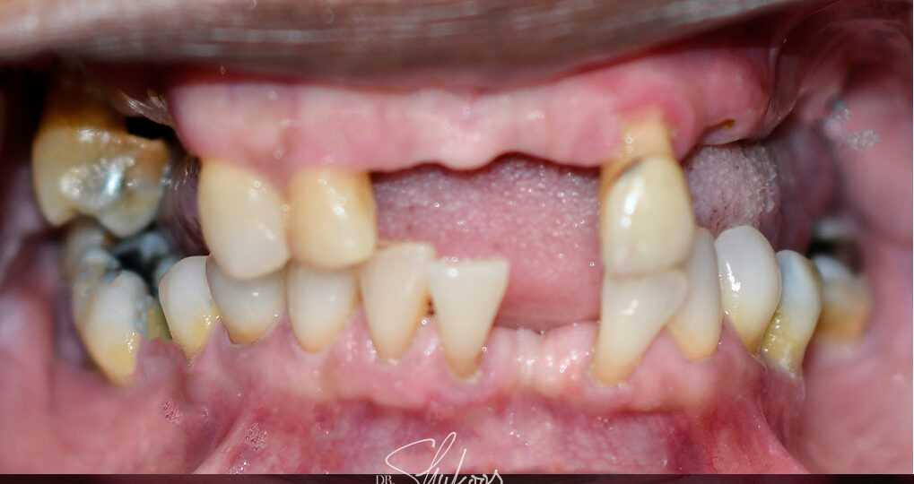 Full-Arch Implants case — Only a few remaining teeth replaced with fixed implant arches, treated by Dr. Kambez Shukoor in Washington, DC — before treatment