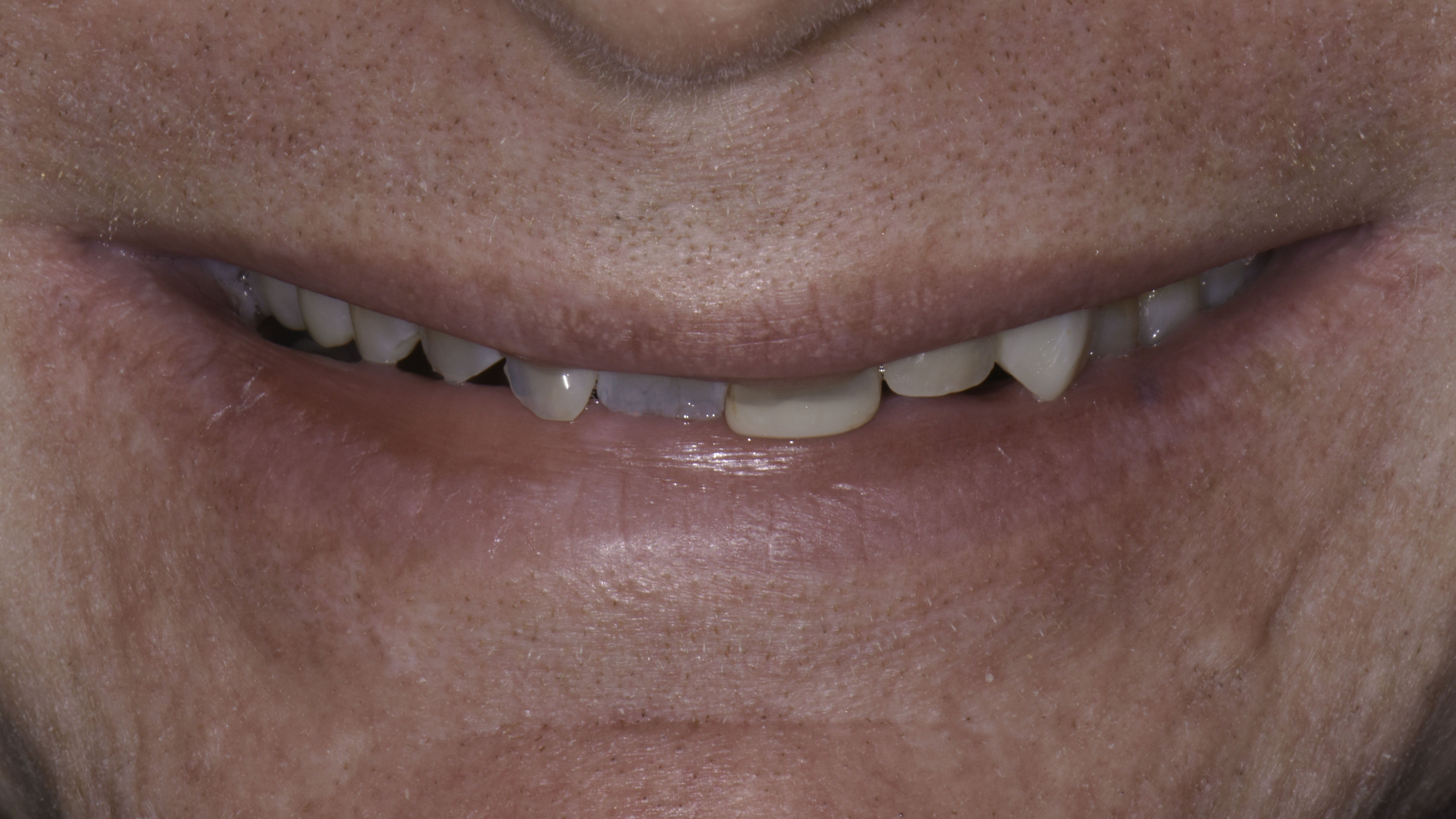 Close-up view — Smile makeover before and after, Damaged and discolored teeth renewed with full-mouth rehabilitation, Washington, DC — before treatment