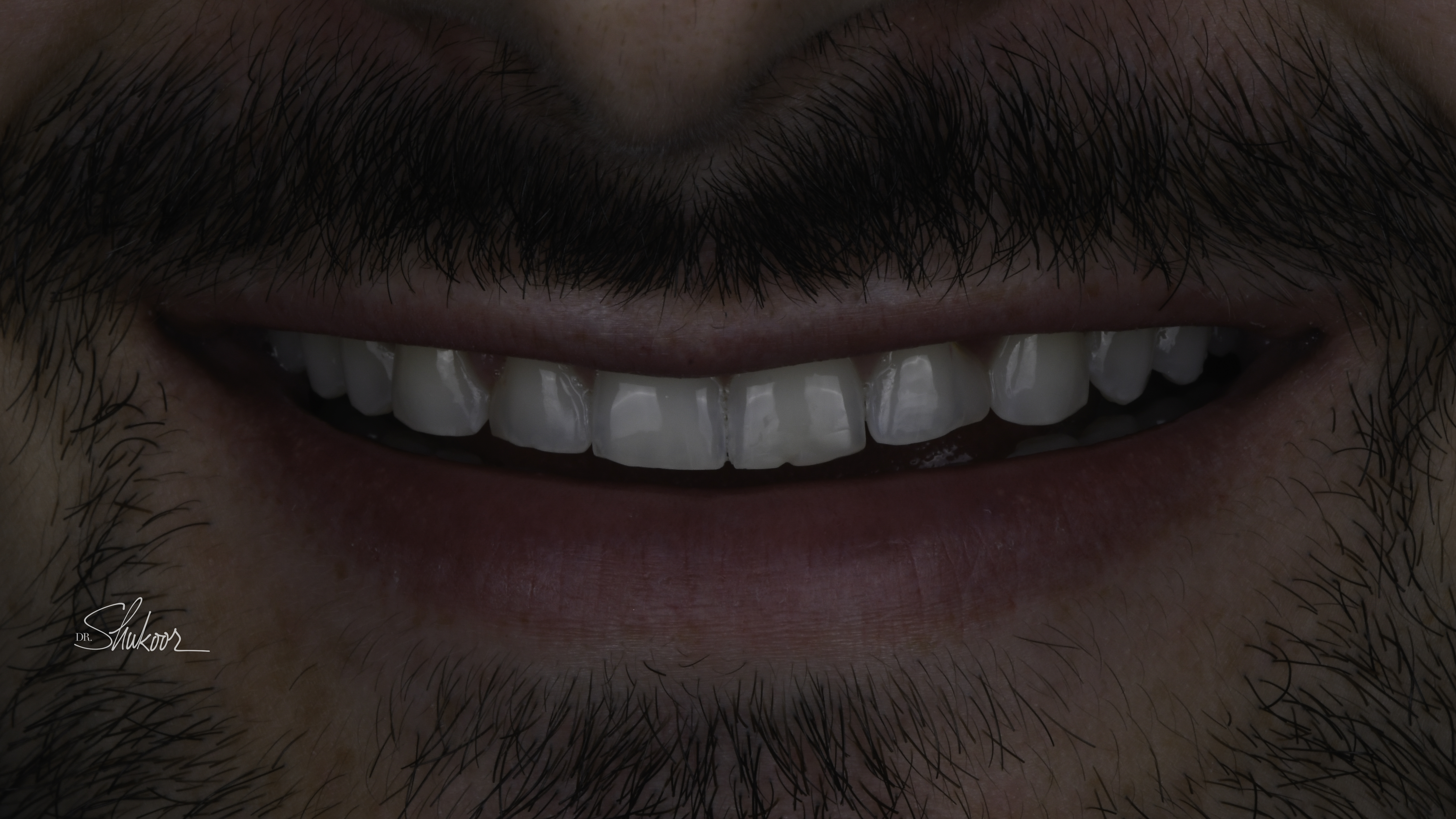 Porcelain veneers before and after — Worn & Uneven Front Teeth Rebuilt With Porcelain Veneers, treated by Dr. Kambez Shukoor in Washington, DC — before treatment