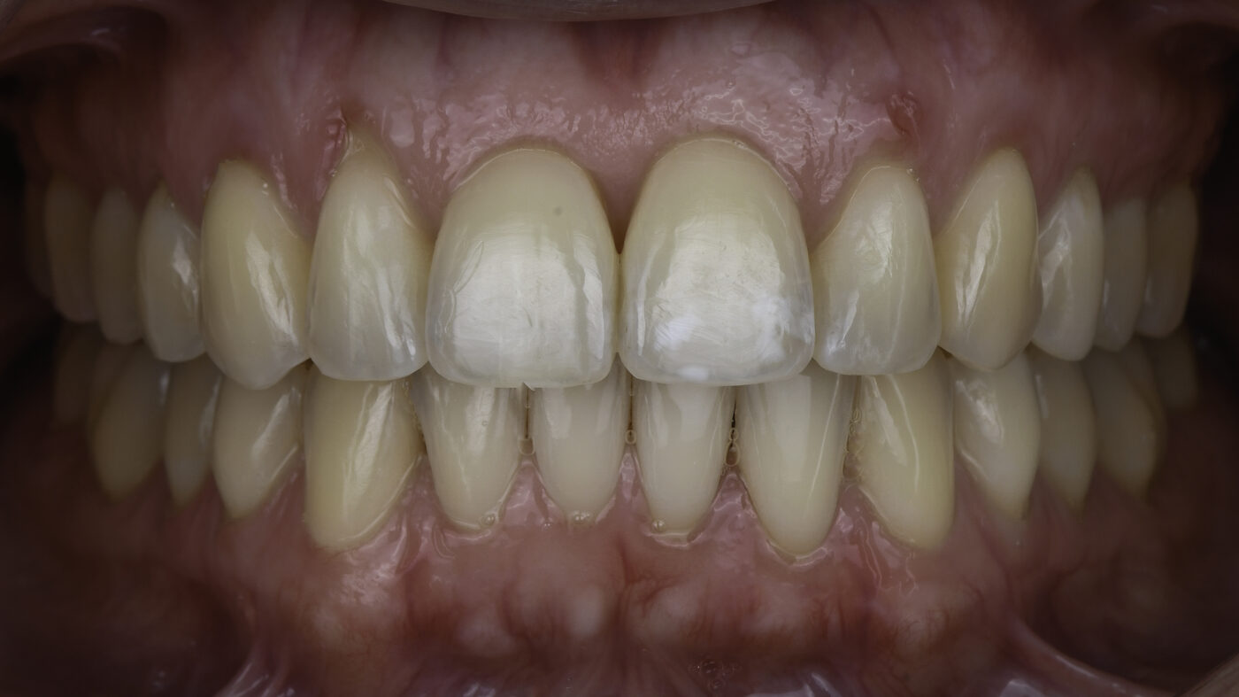 Clear Aligners case — Worn, uneven incisal edges realigned with clear aligners, treated by Dr. Kambez Shukoor in Washington, DC — after treatment