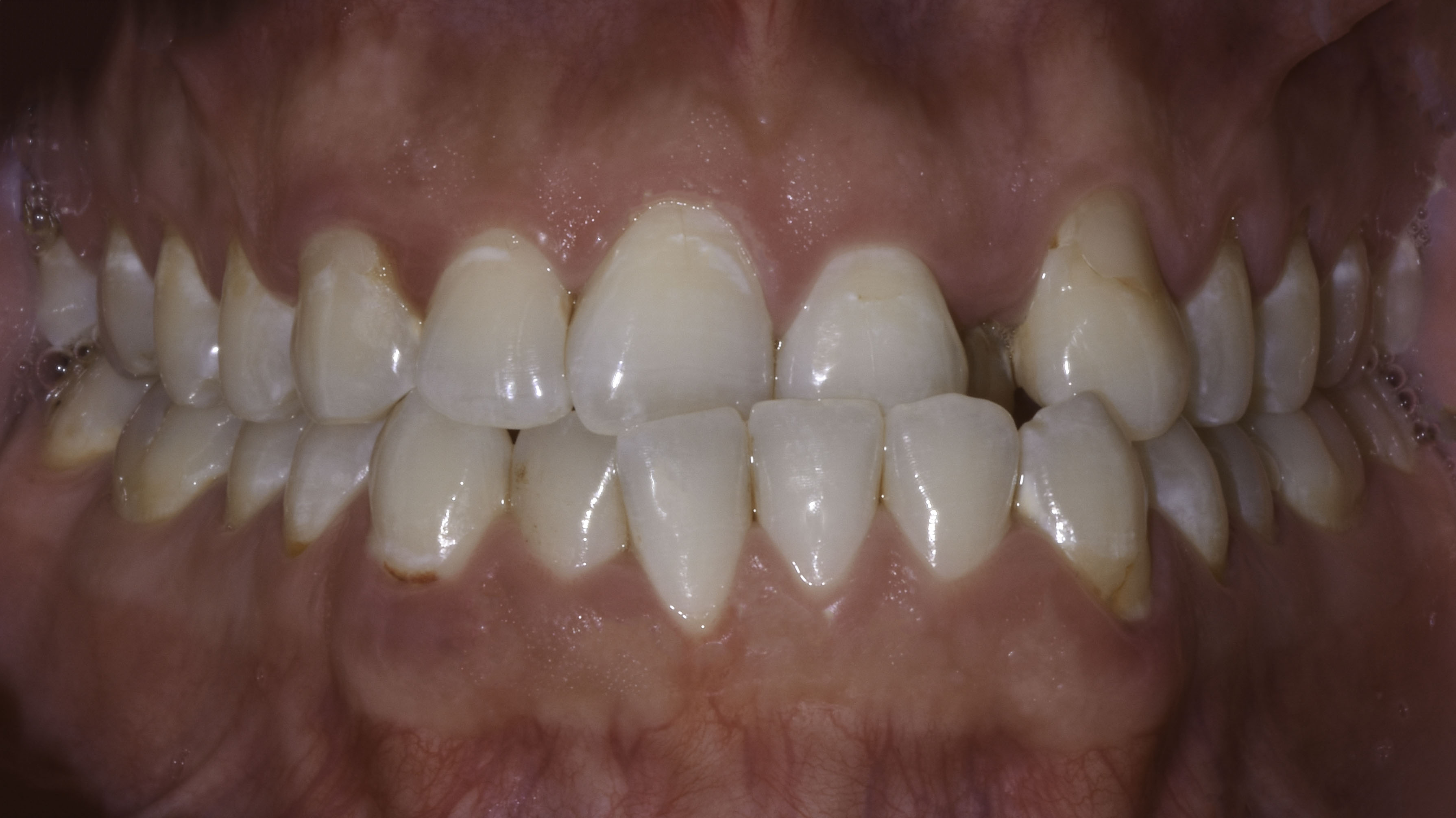 Clear aligners before and after, close-up view — Crowded arch expanded and leveled with clear aligners, treated by Dr. Kambez Shukoor in Washington, DC — before treatment