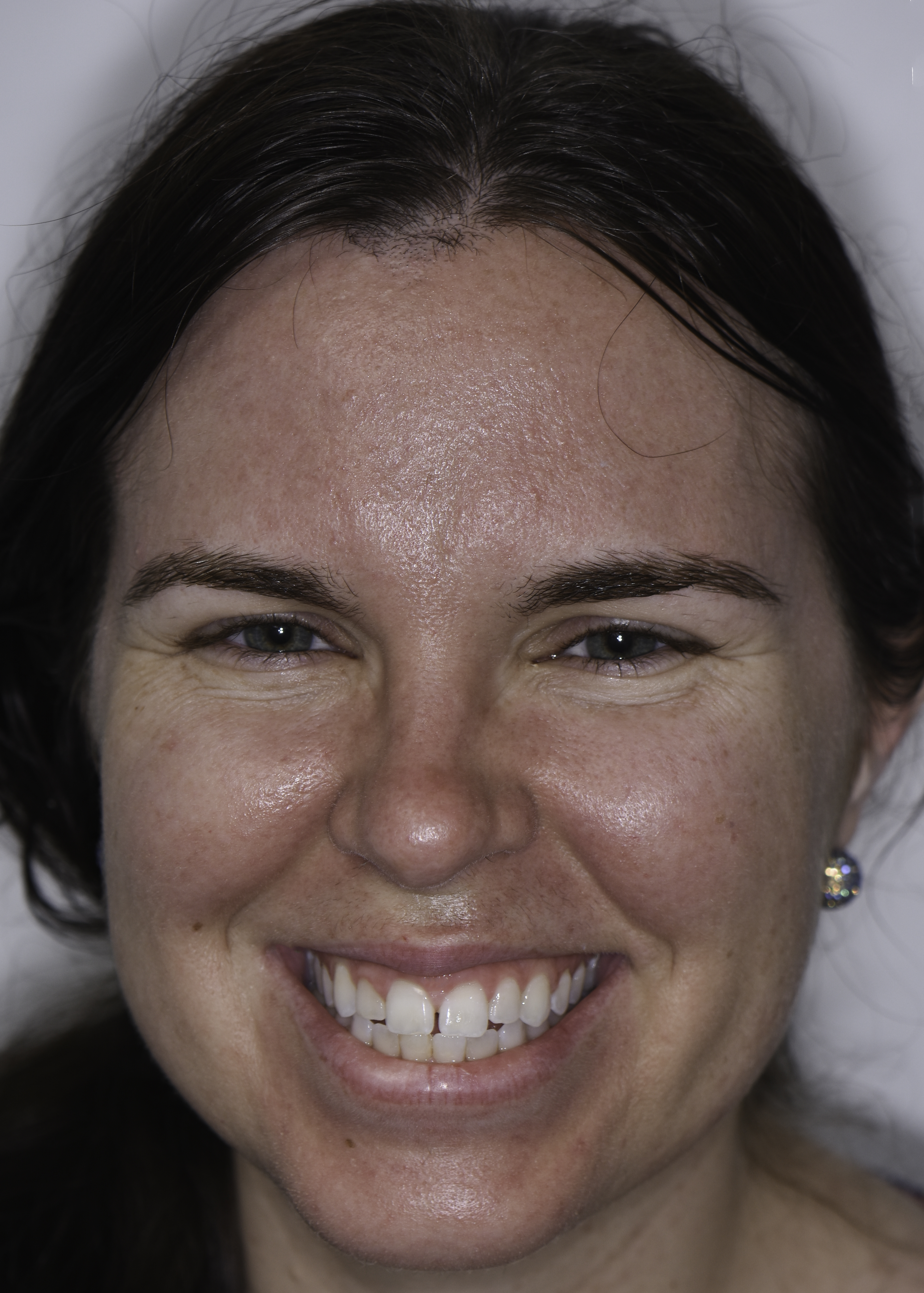 Clear aligners before and after — Uneven spacing and rotation corrected with clear aligners, treated by Dr. Kambez Shukoor in Washington, DC — before treatment