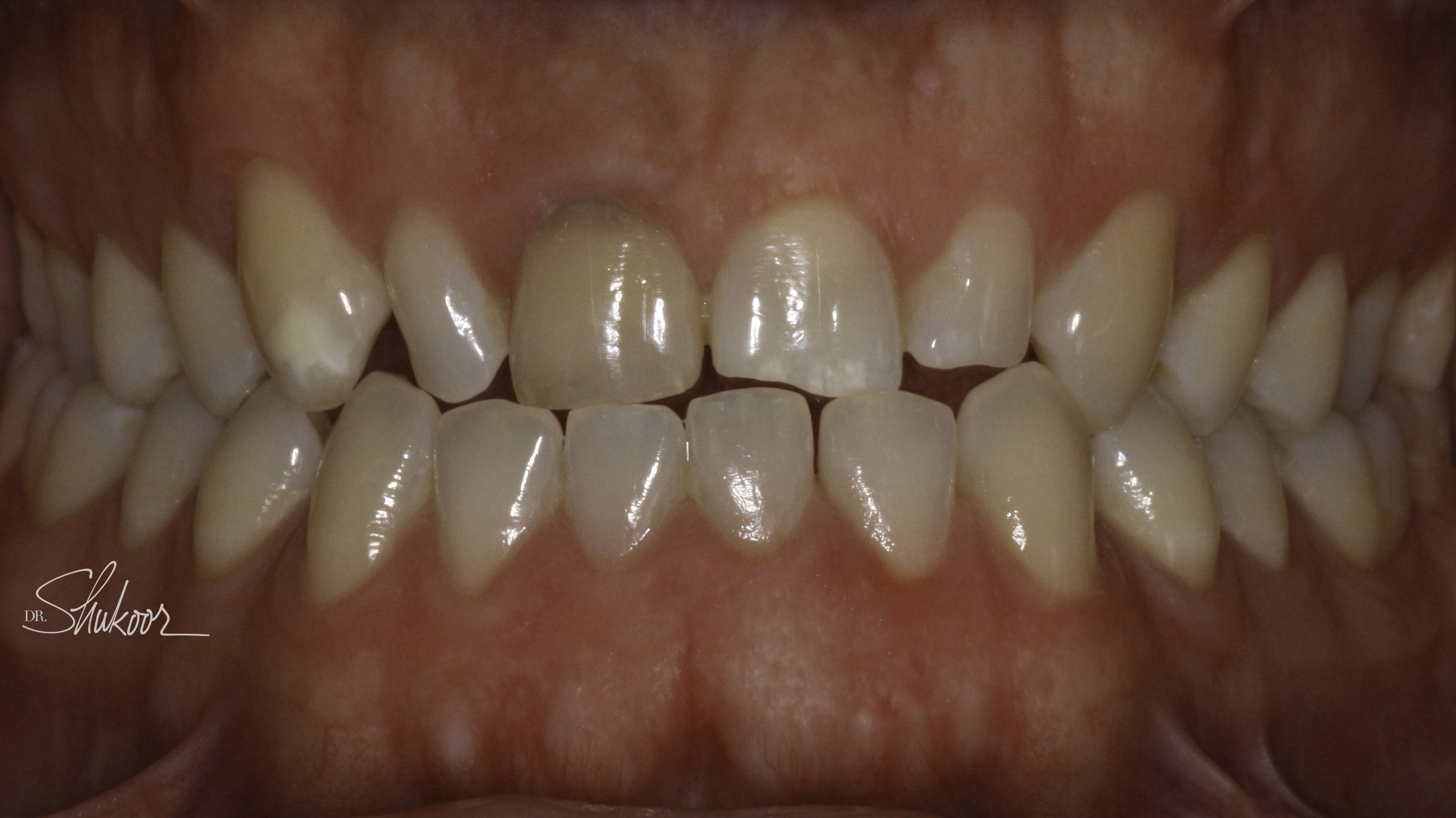Smile makeover before and after — Smile makeover transforms shape, shade, and alignment, treated by Dr. Kambez Shukoor in Washington, DC — before treatment