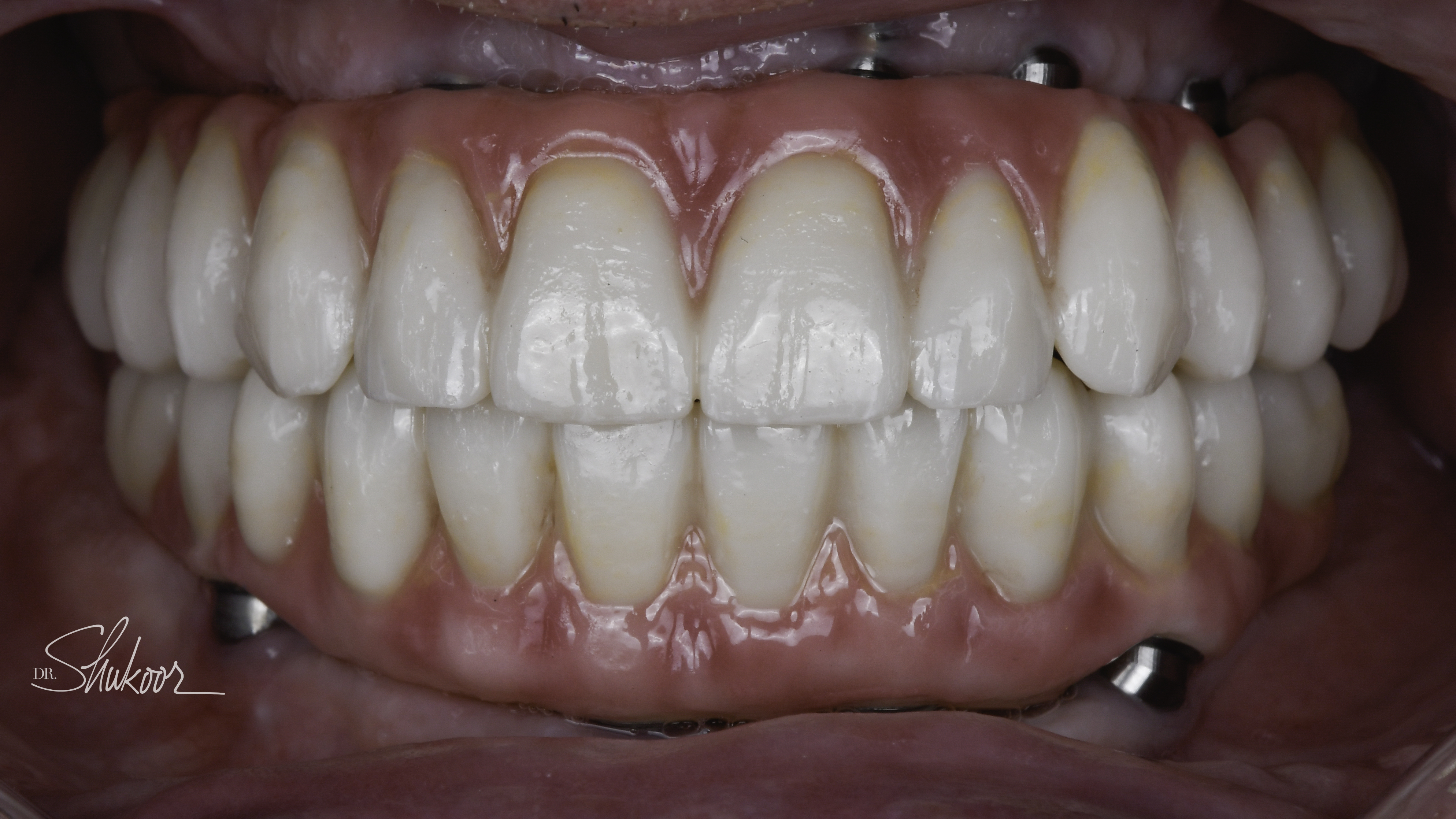 Retracted view — Full-arch implant before and after, Advanced periodontal breakdown treated with full-arch implants, Washington, DC — after treatment
