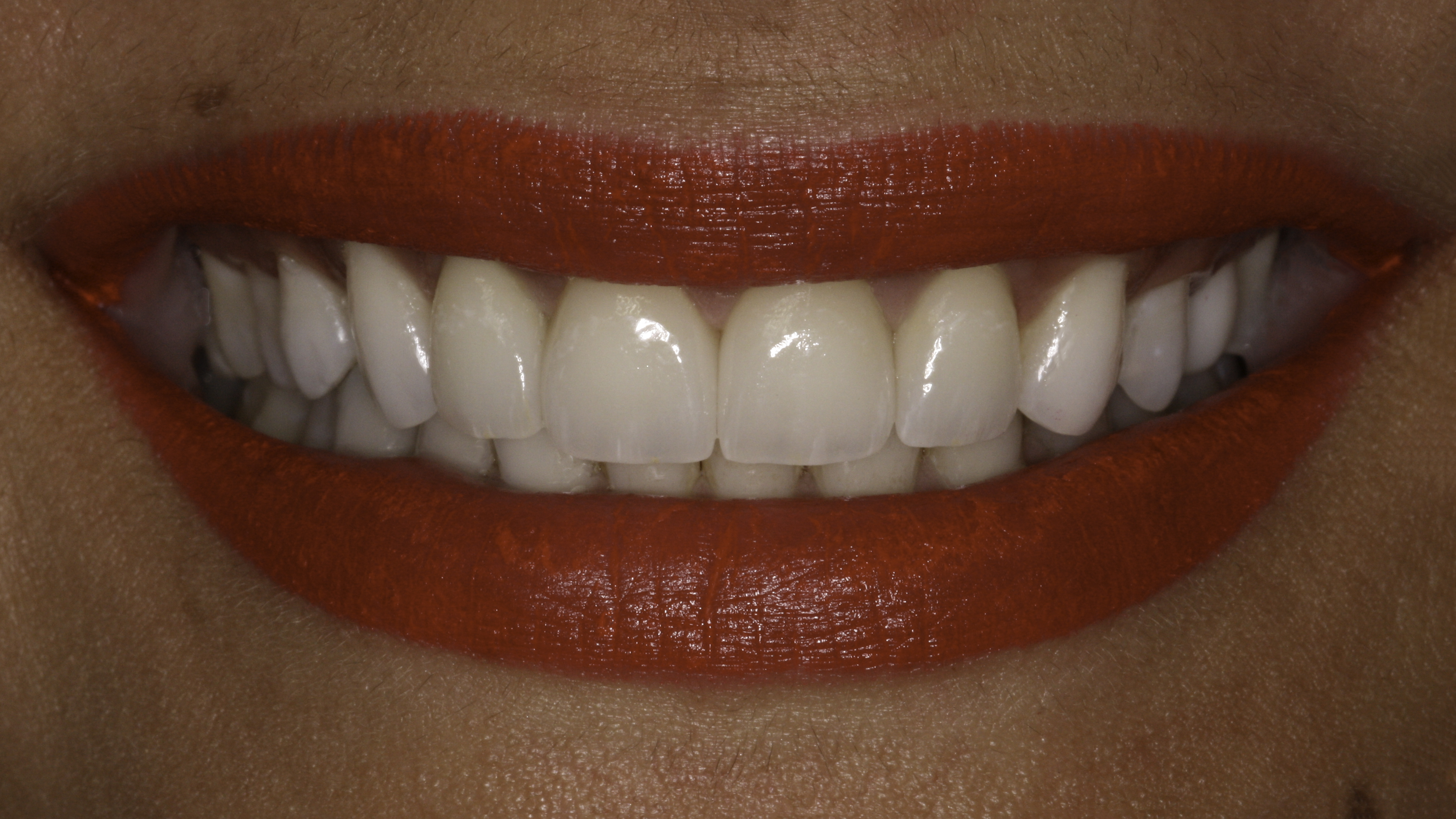 Porcelain veneers before and after — Gap Between Front Teeth Closed With Porcelain Veneers, treated by Dr. Kambez Shukoor in Washington, DC — after treatment