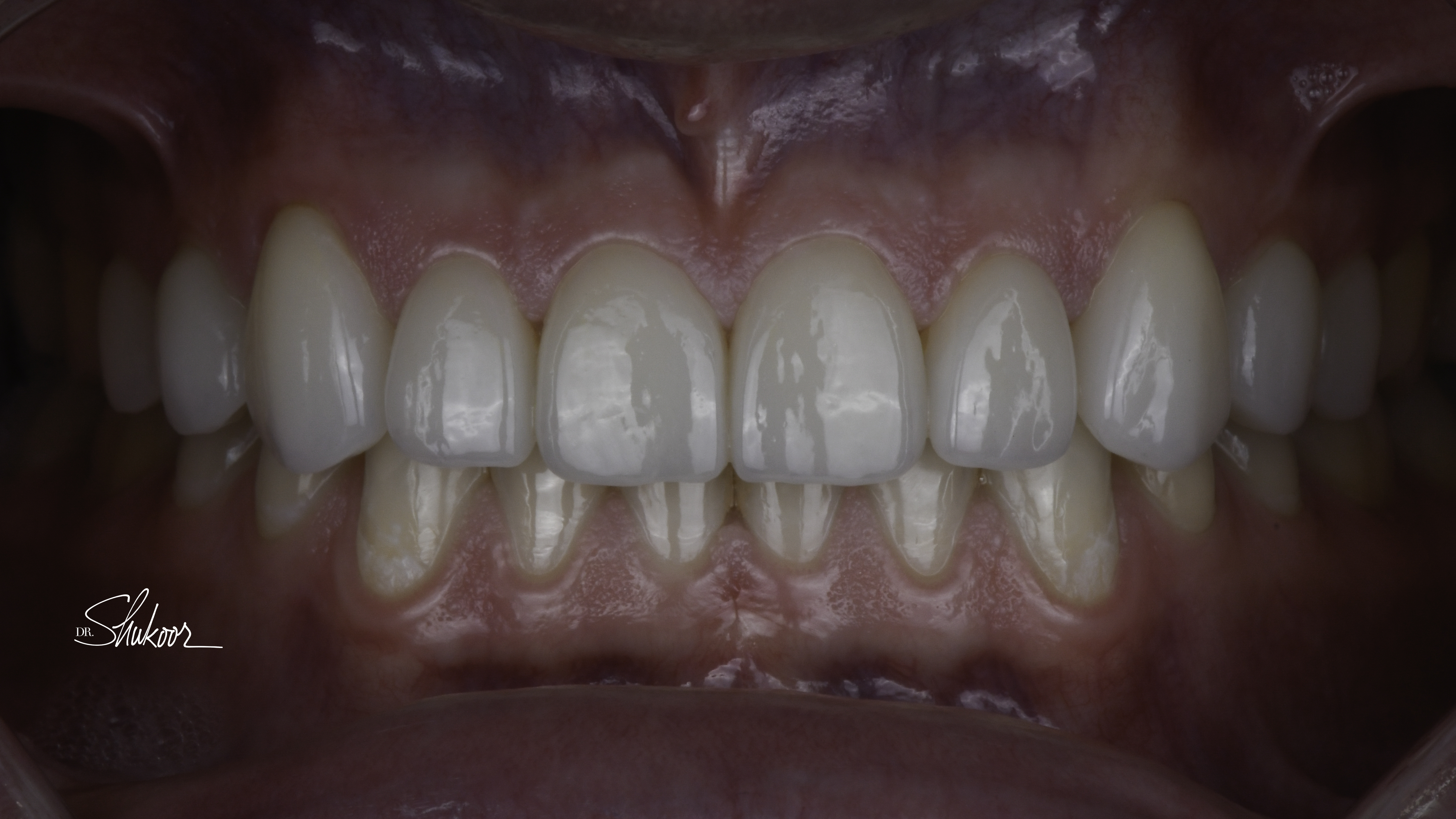 Retracted view — porcelain veneers before and after, Worn & Uneven Front Teeth Rebuilt With Porcelain Veneers, Washington, DC — after treatment