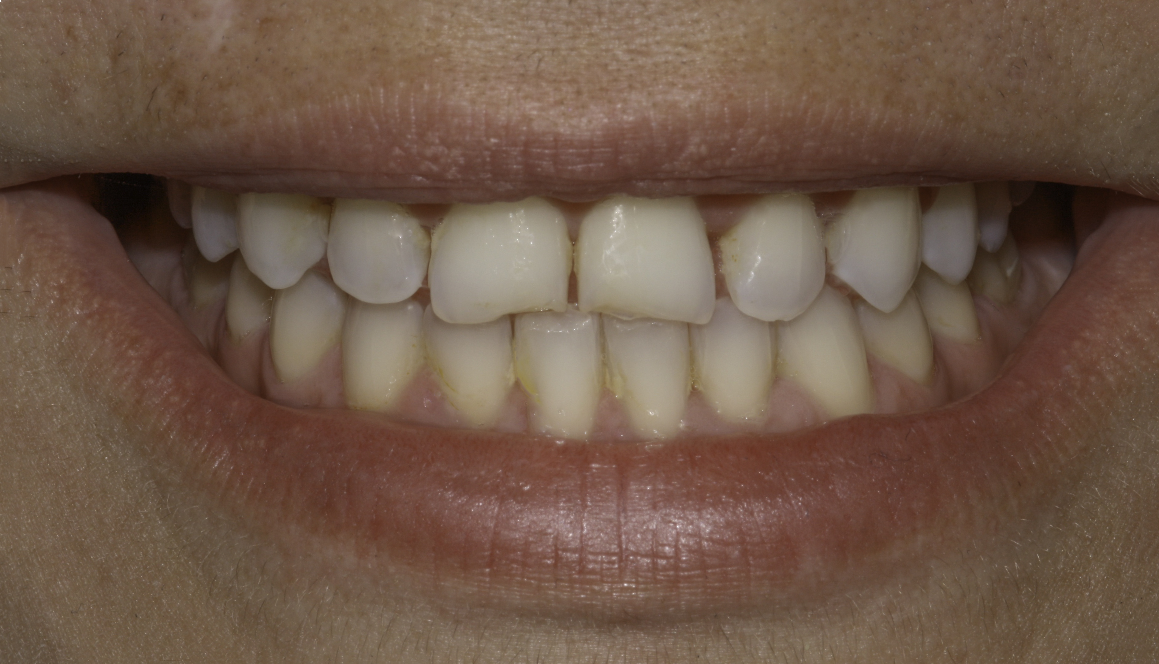 Porcelain veneers before and after — Chipped, worn, and discolored front teeth renewed with porcelain veneers, treated by Dr. Kambez Shukoor in Washington, DC — before treatment