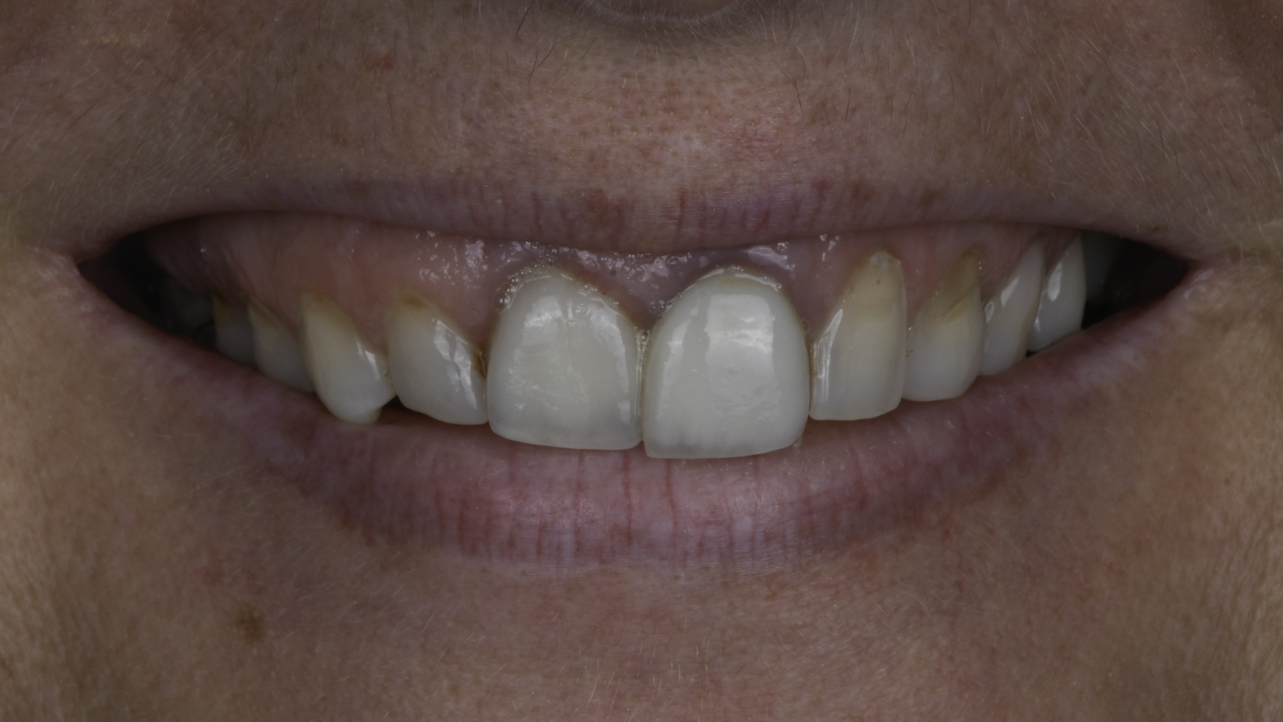 Full-arch implant before and after — Dark, aging front crowns renewed with implant restorations, treated by Dr. Kambez Shukoor in Washington, DC — before treatment