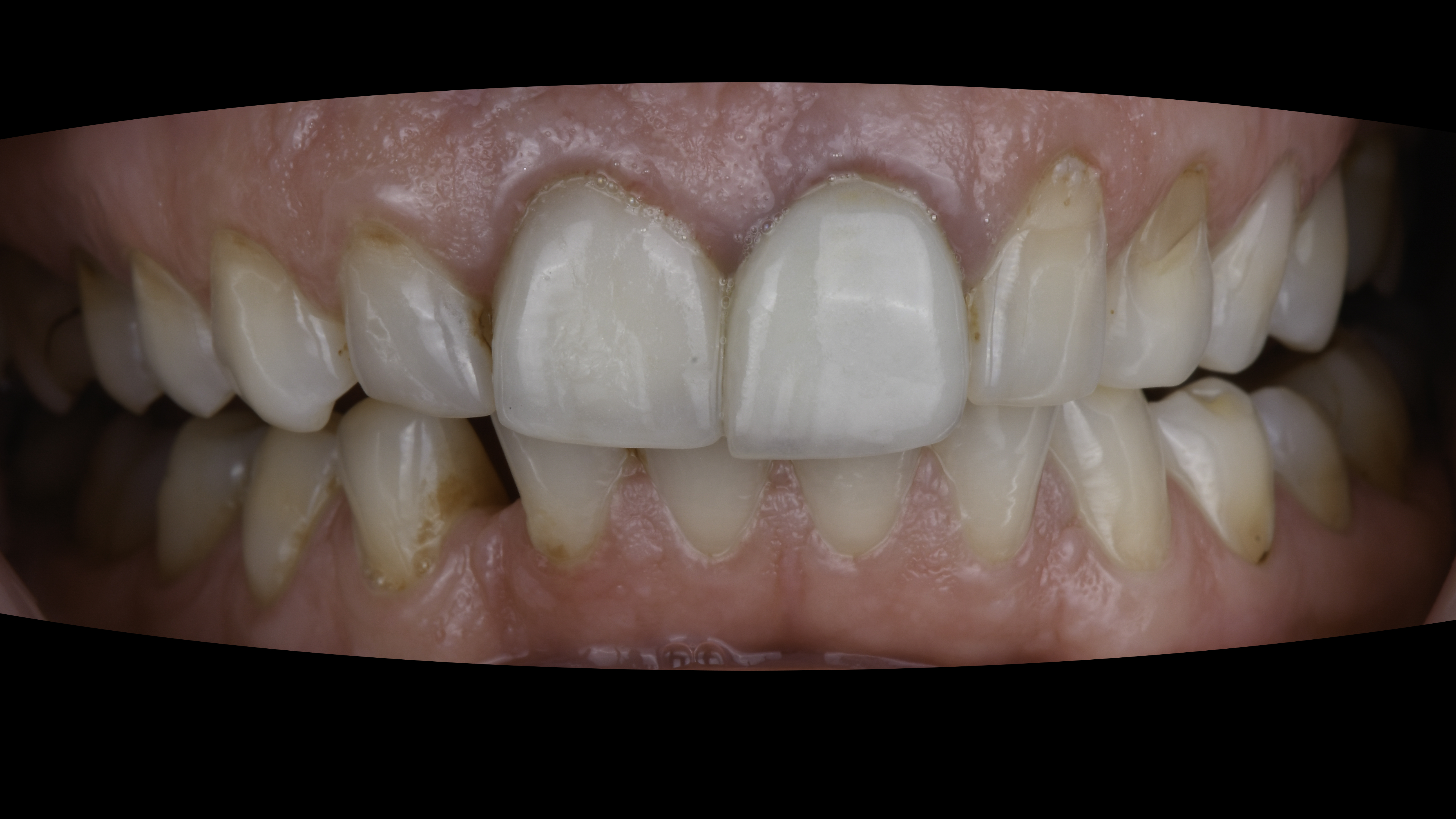 Retracted view — Full-arch implant before and after, Dark, aging front crowns renewed with implant restorations, Washington, DC — before treatment