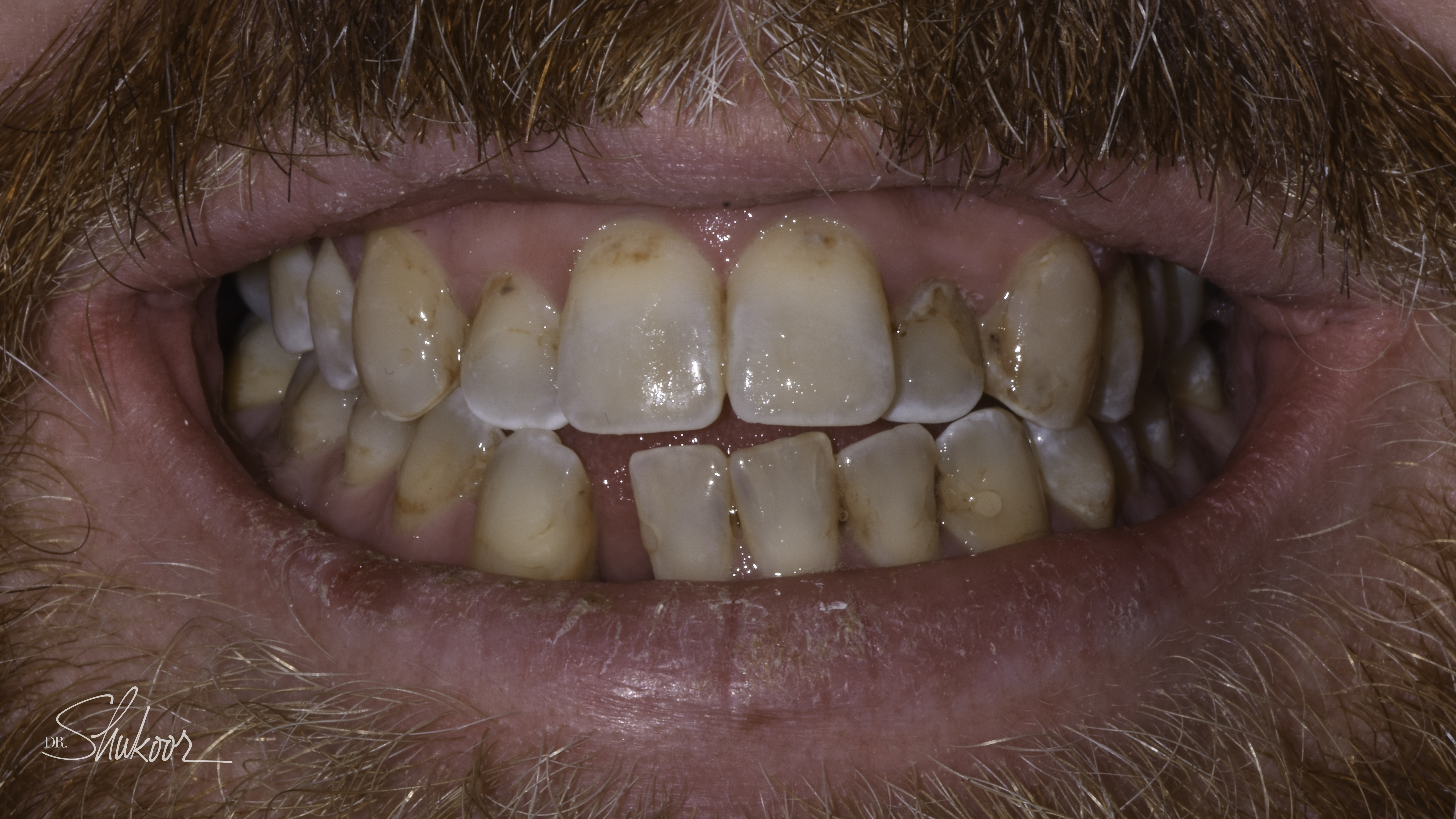 Close-up view — Smile makeover before and after, Smile makeover restores symmetry and a healthy shade, Washington, DC — before treatment