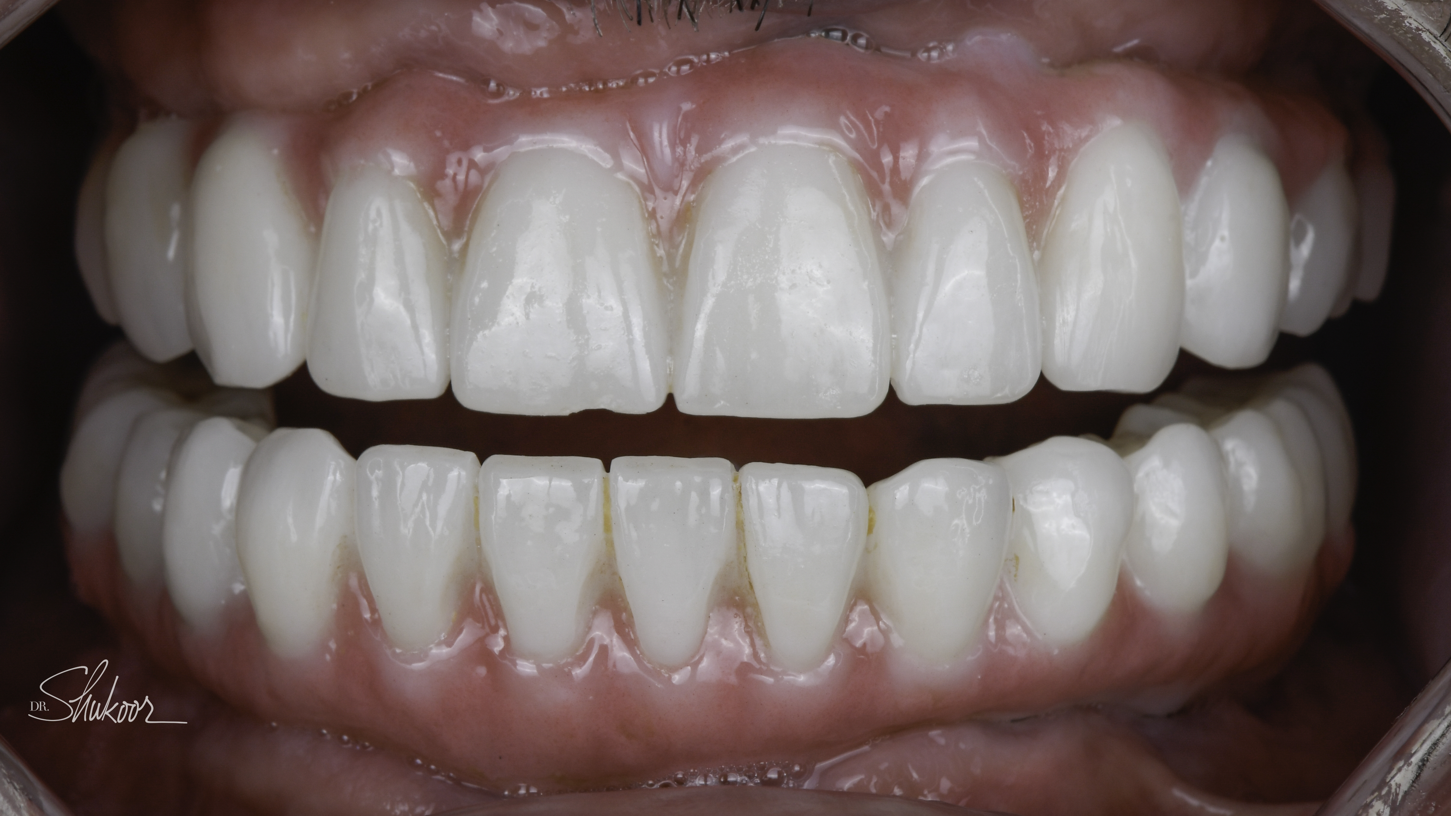 Retracted view — Full-arch implant before and after, Worn, discolored dentition restored with full-arch implants, Washington, DC — after treatment