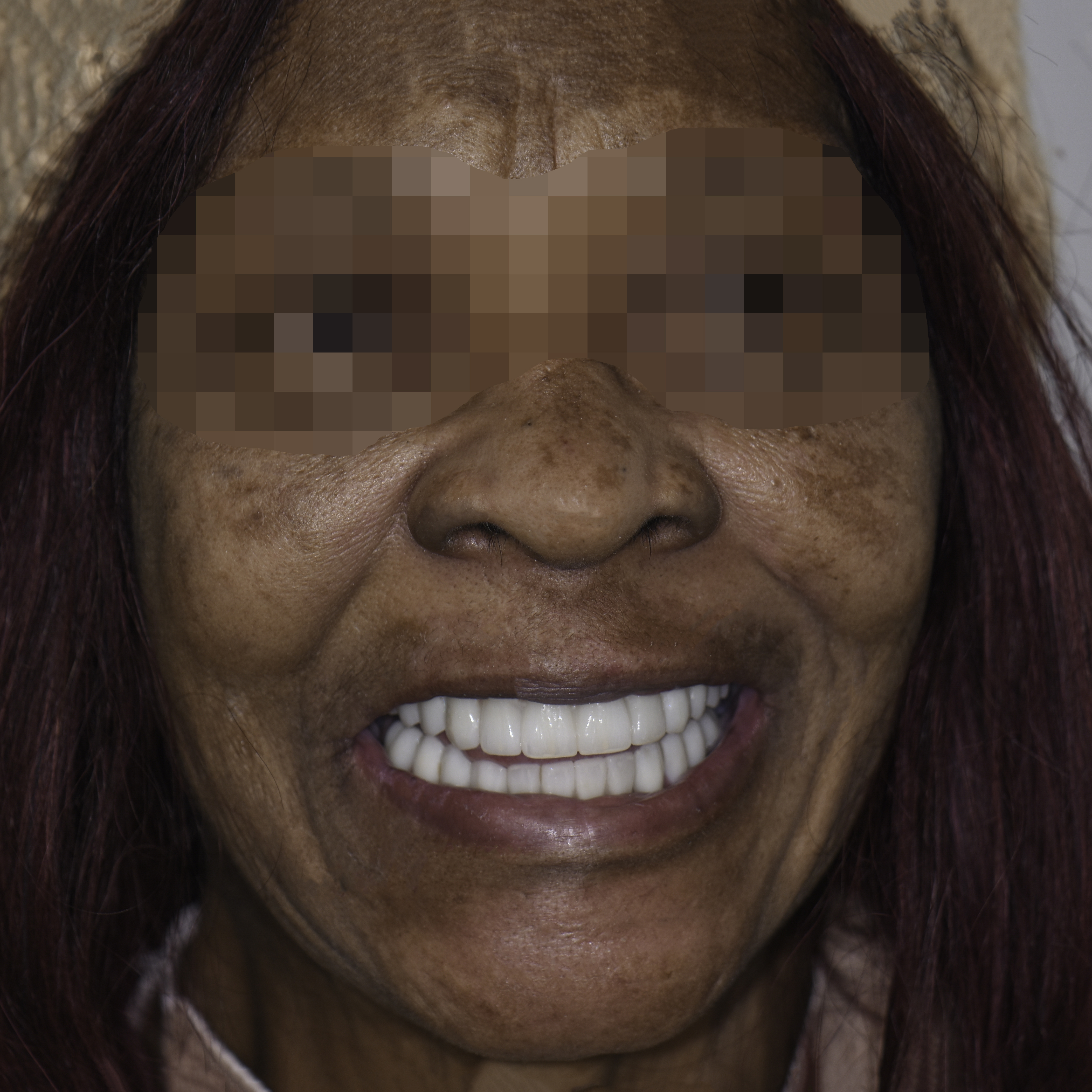 Full-arch implant before and after — Failing upper teeth replaced with a fixed implant-supported arch, treated by Dr. Kambez Shukoor in Washington, DC — after treatment