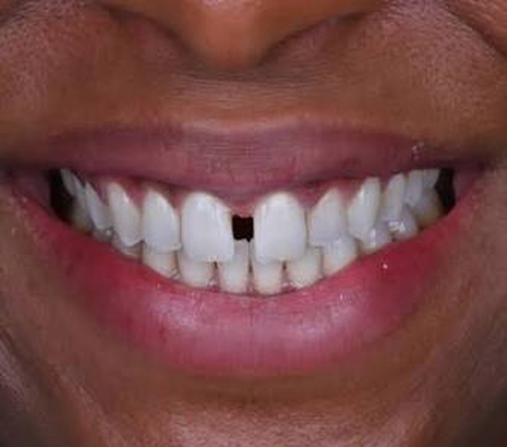 Gap Closure before and after result — Spacing between the upper front teeth closed with veneers, treated by Dr. Kambez Shukoor in Washington, DC — before treatment