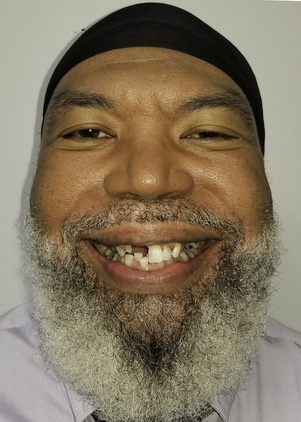 Full-Arch Implants case — Broken-down teeth rebuilt with full-arch implant restoration, treated by Dr. Kambez Shukoor in Washington, DC — before treatment