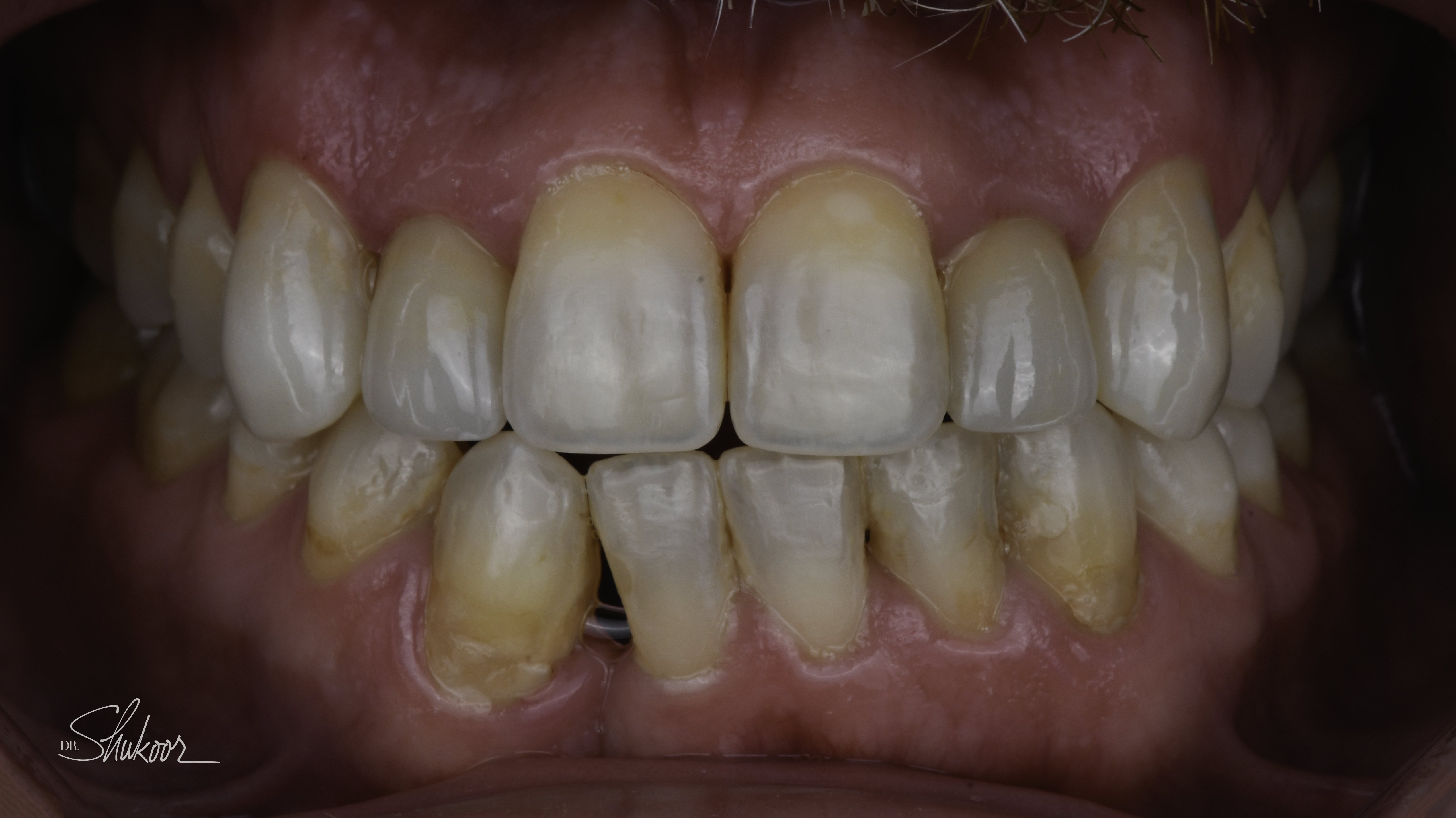 Smile makeover before and after — Smile makeover restores symmetry and a healthy shade, treated by Dr. Kambez Shukoor in Washington, DC — after treatment