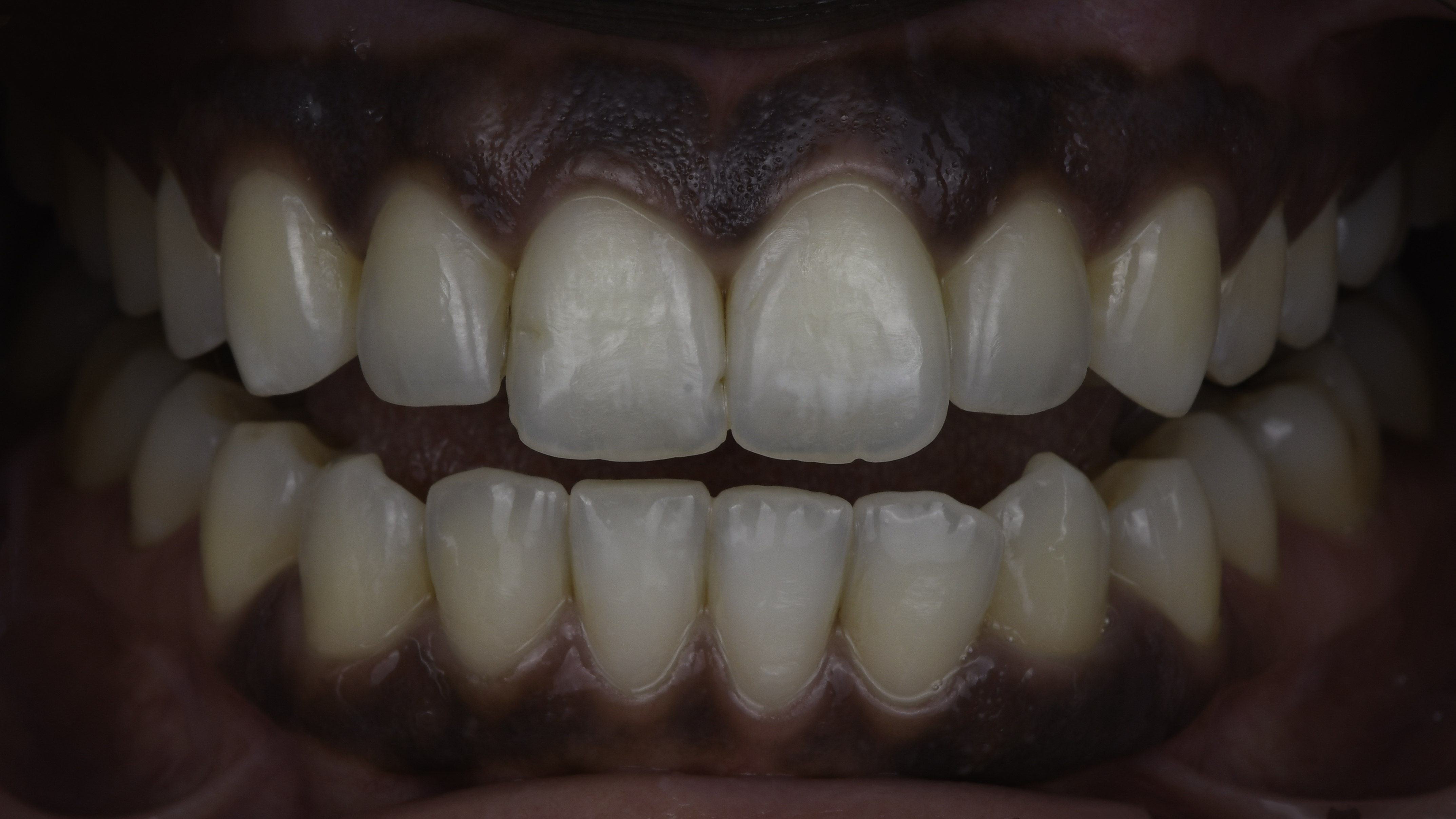 Clear aligners before and after, close-up view — Crowded upper and lower front teeth aligned with clear aligners, treated by Dr. Kambez Shukoor in Washington, DC — after treatment