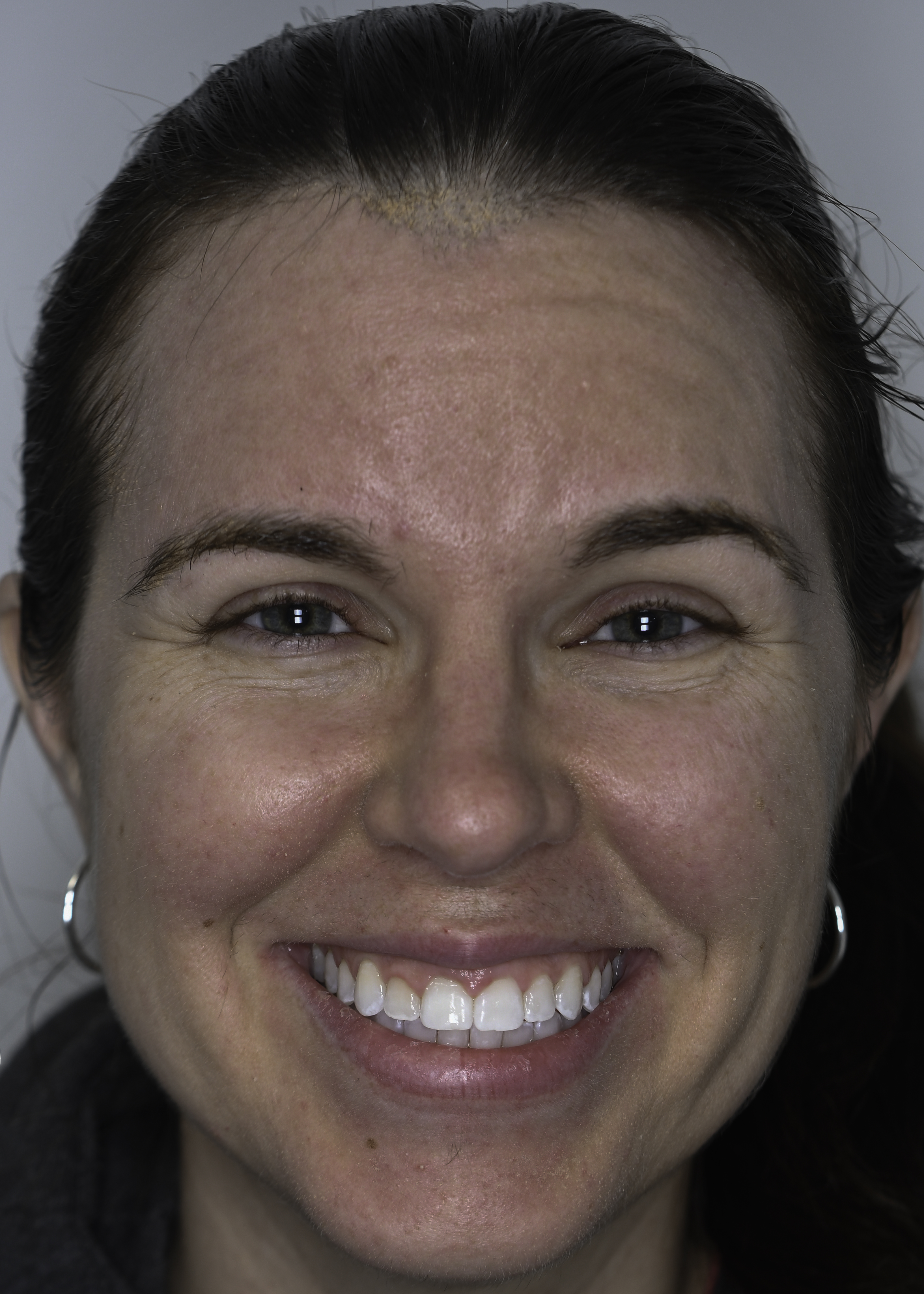 Clear aligners before and after — Uneven spacing and rotation corrected with clear aligners, treated by Dr. Kambez Shukoor in Washington, DC — after treatment