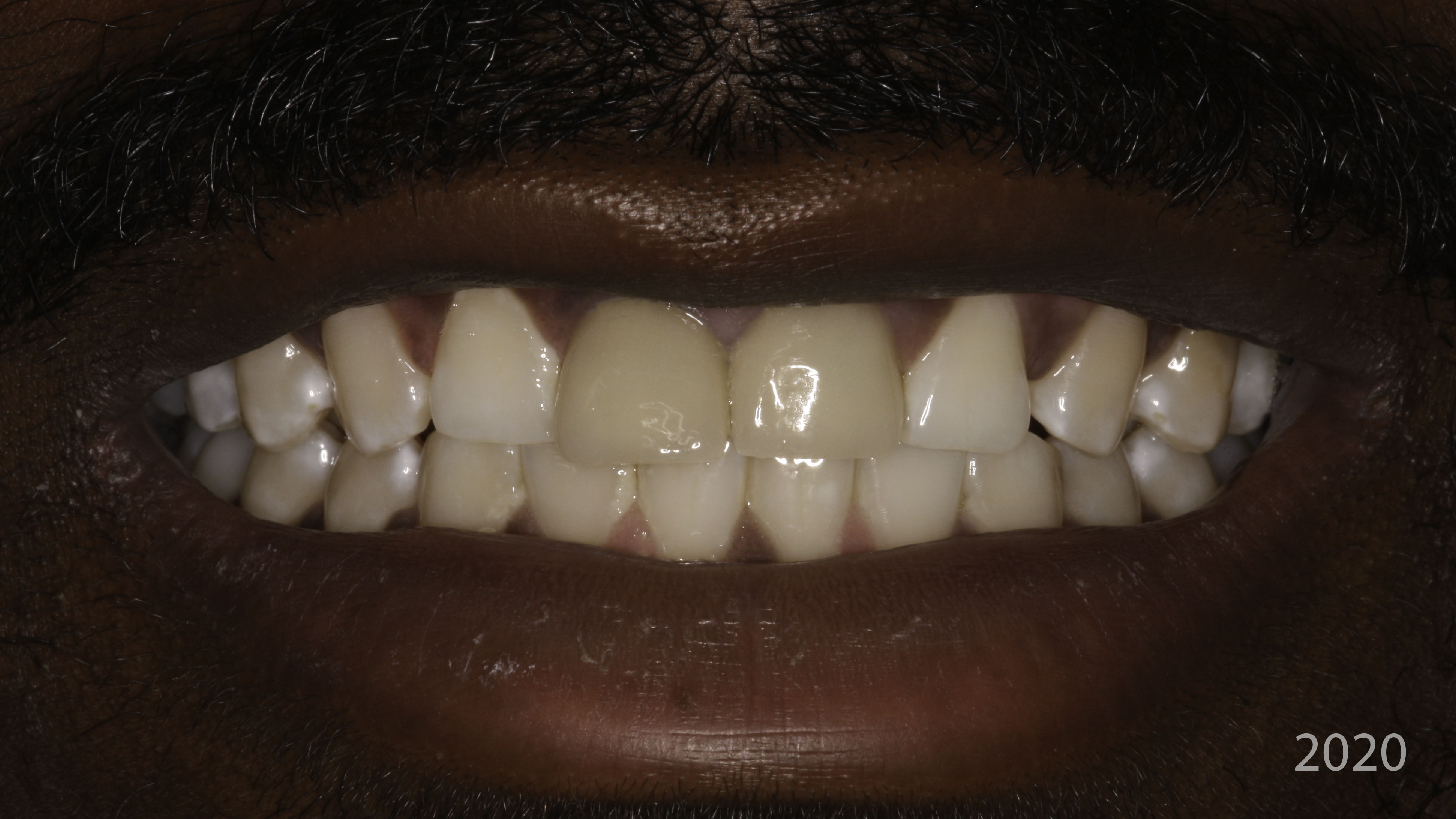 Full-arch implant before and after — Worn, discolored front teeth restored with implant crowns, treated by Dr. Kambez Shukoor in Washington, DC — before treatment