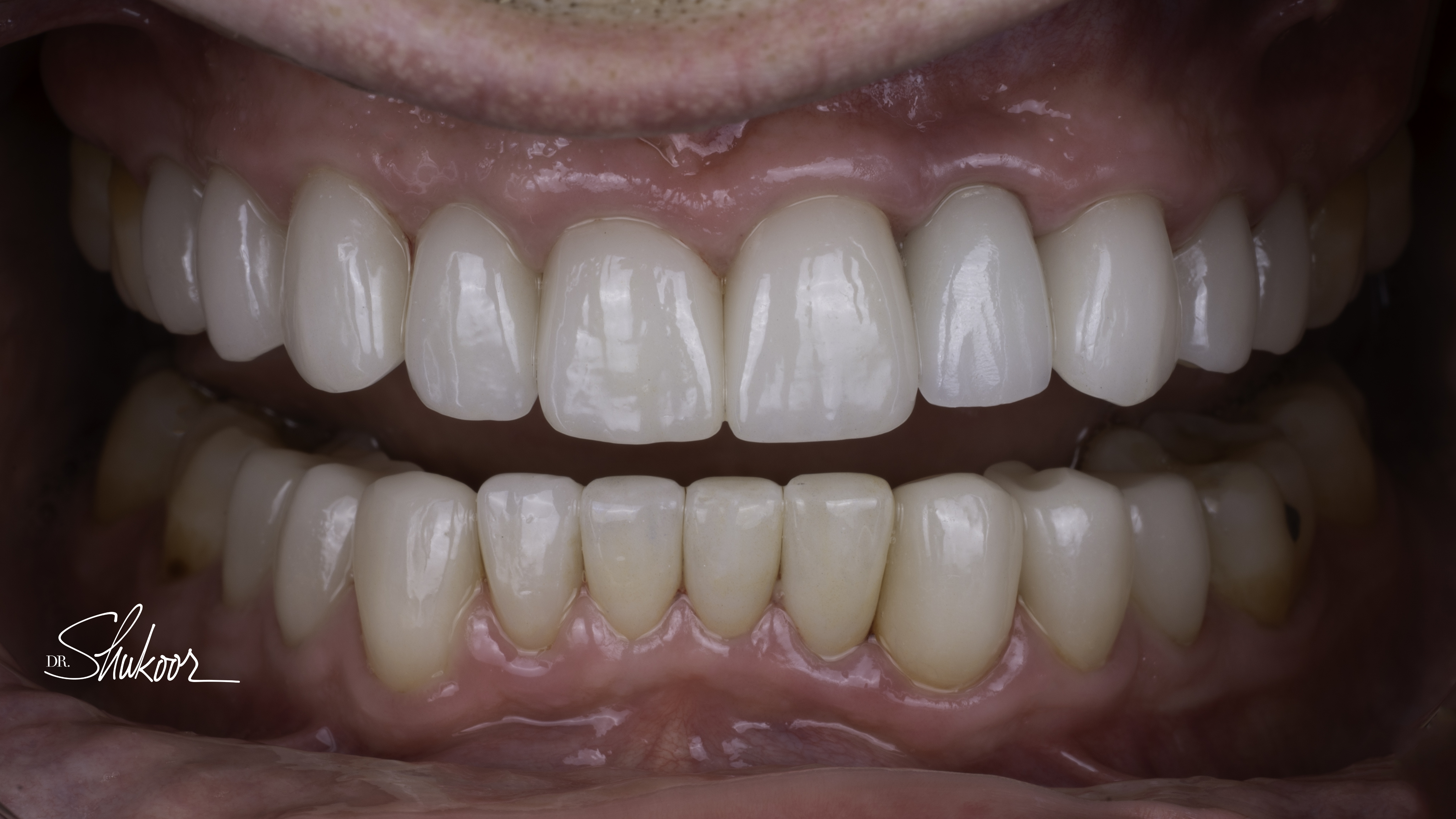 Retracted view — Smile makeover before and after, Damaged and discolored teeth renewed with full-mouth rehabilitation, Washington, DC — after treatment