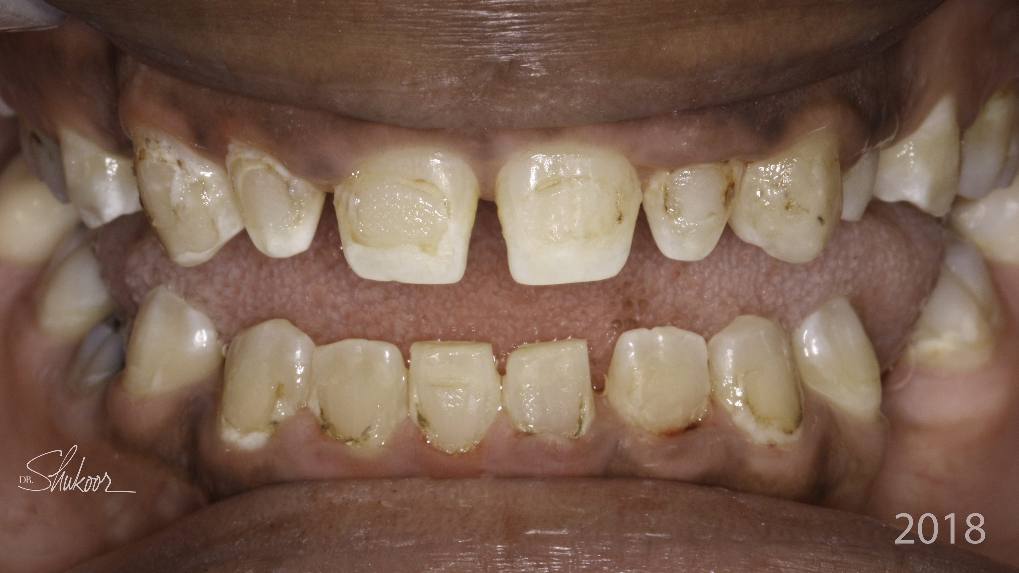 Retracted view — Smile makeover before and after, Complete smile makeover for a brighter, balanced smile, Washington, DC — before treatment