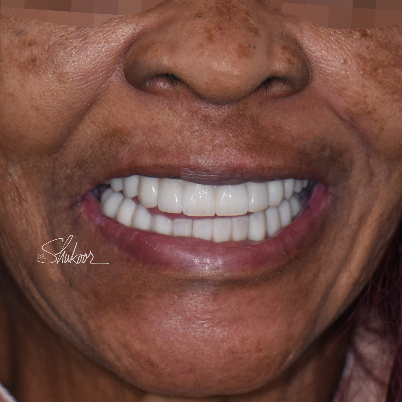 Full-arch implant before and after — Failing upper teeth replaced with a fixed implant-supported arch, treated by Dr. Kambez Shukoor in Washington, DC — after treatment