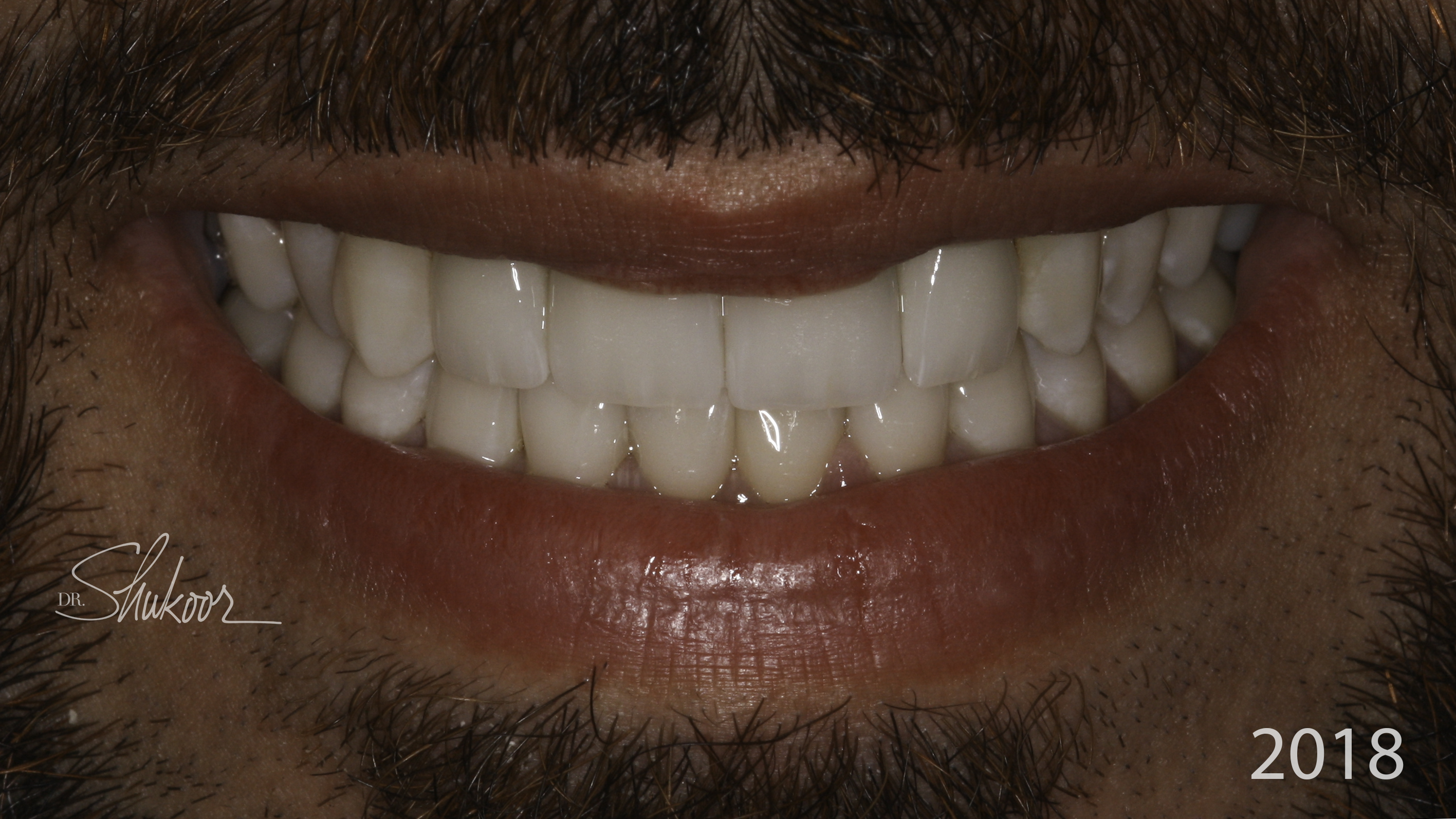 Porcelain veneers before and after — Mismatched Front Teeth Evened Out With Veneers, treated by Dr. Kambez Shukoor in Washington, DC — after treatment
