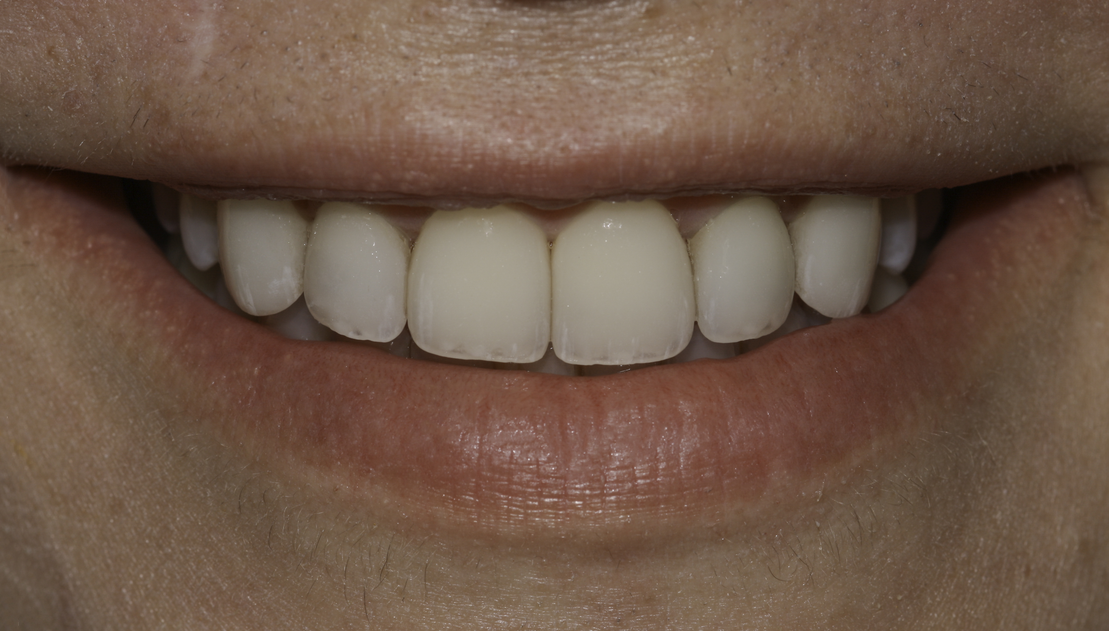 Porcelain veneers before and after — Chipped, worn, and discolored front teeth renewed with porcelain veneers, treated by Dr. Kambez Shukoor in Washington, DC — after treatment