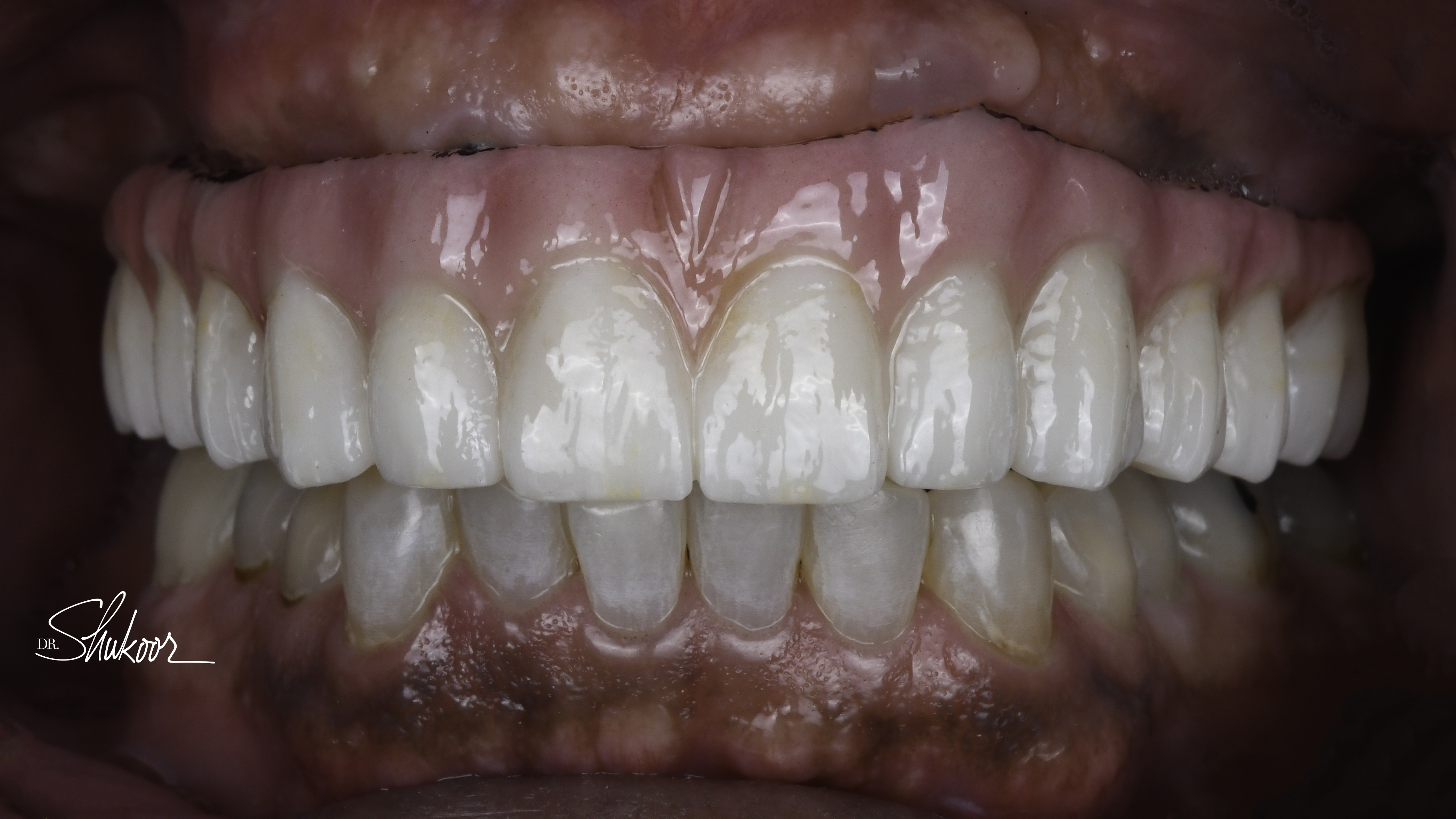 Retracted view — Full-arch implant before and after, Broken-down teeth rebuilt with full-arch implant restoration, Washington, DC — after treatment