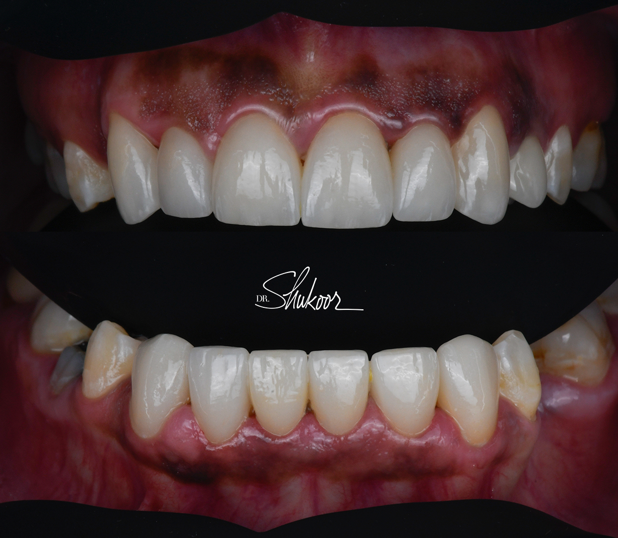 Retracted view — Smile makeover before and after, Complete smile makeover for a brighter, balanced smile, Washington, DC — after treatment
