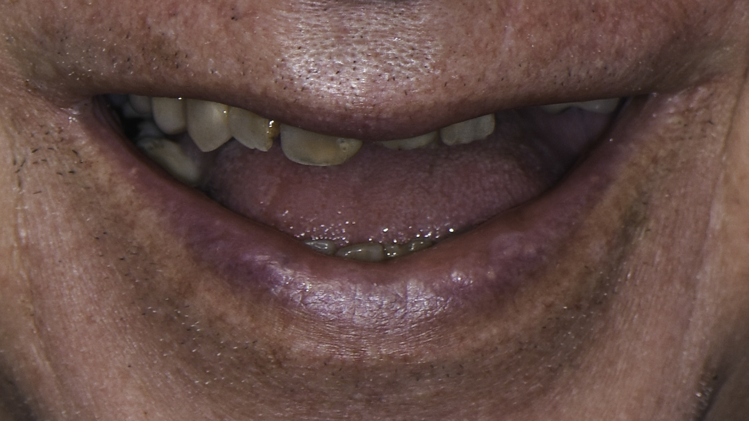 Smile view — Full-arch implant before and after, Advanced periodontal breakdown treated with full-arch implants, Washington, DC — before treatment