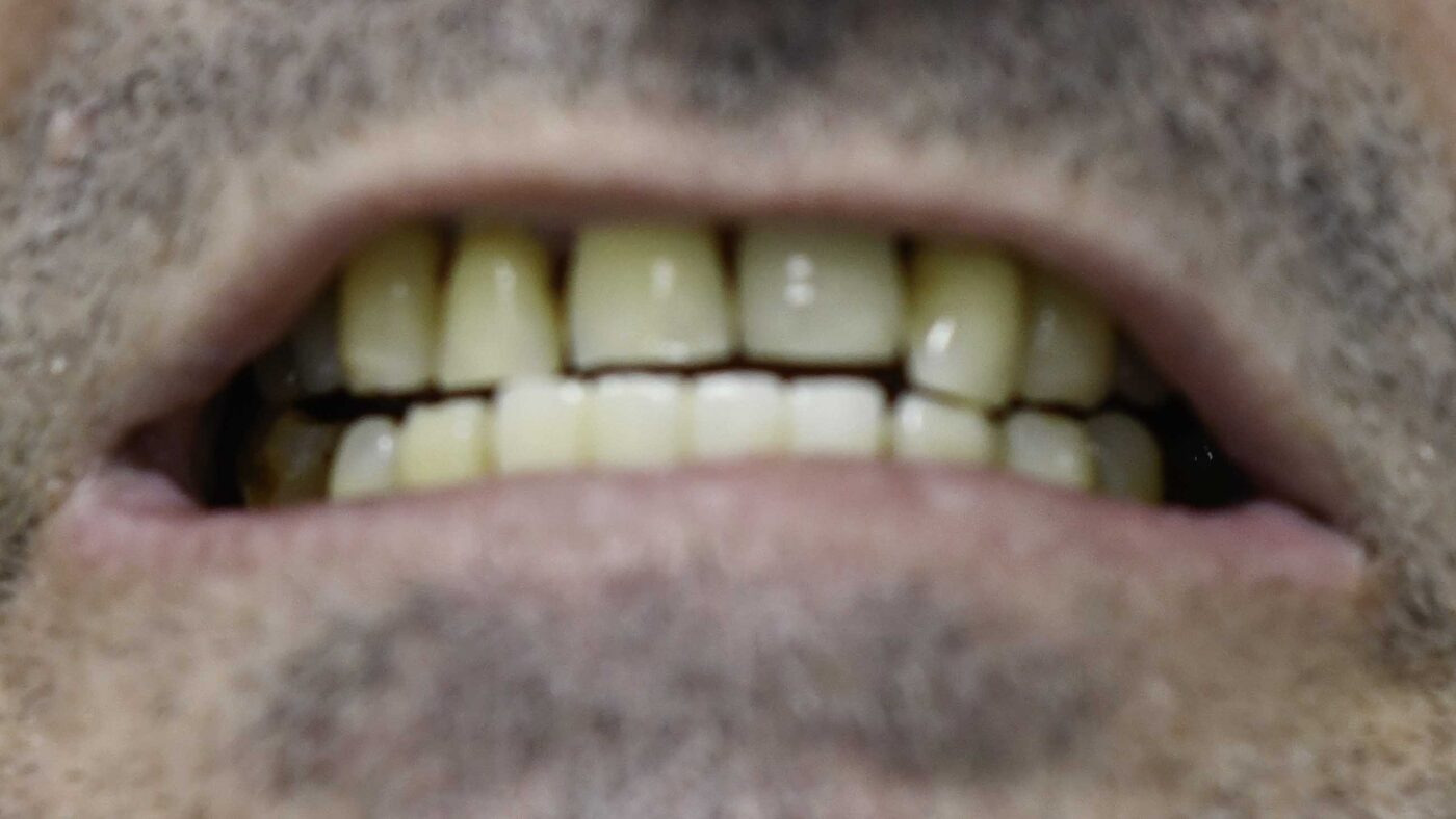 Full-Arch Implants case — Worn, discolored dentition restored with full-arch implants, treated by Dr. Kambez Shukoor in Washington, DC — before treatment