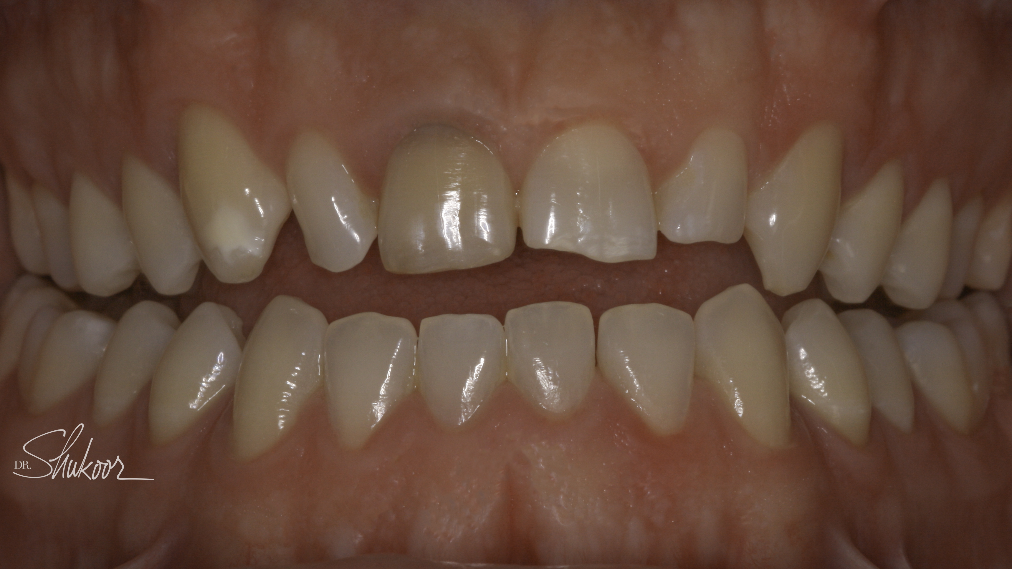 Retracted view — Smile makeover before and after, Worn, discolored smile rebuilt with a complete smile makeover, Washington, DC — before treatment