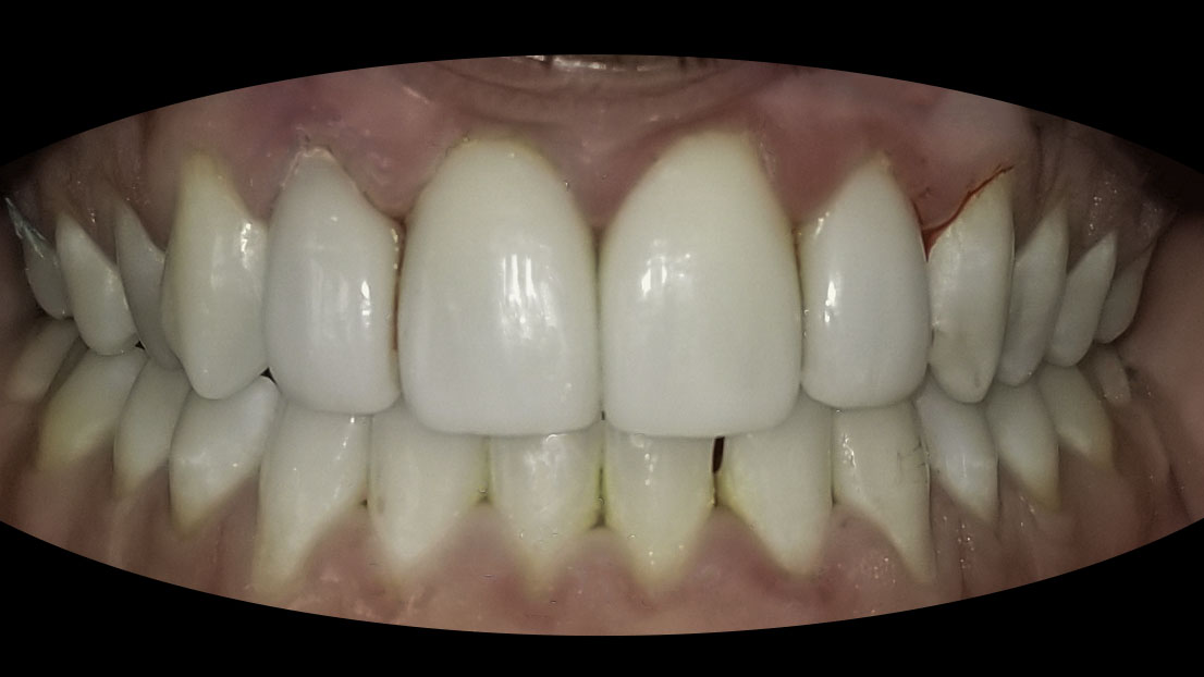 Porcelain veneers before and after — Mismatched Front Teeth Evened Out With Veneers, treated by Dr. Kambez Shukoor in Washington, DC — before treatment