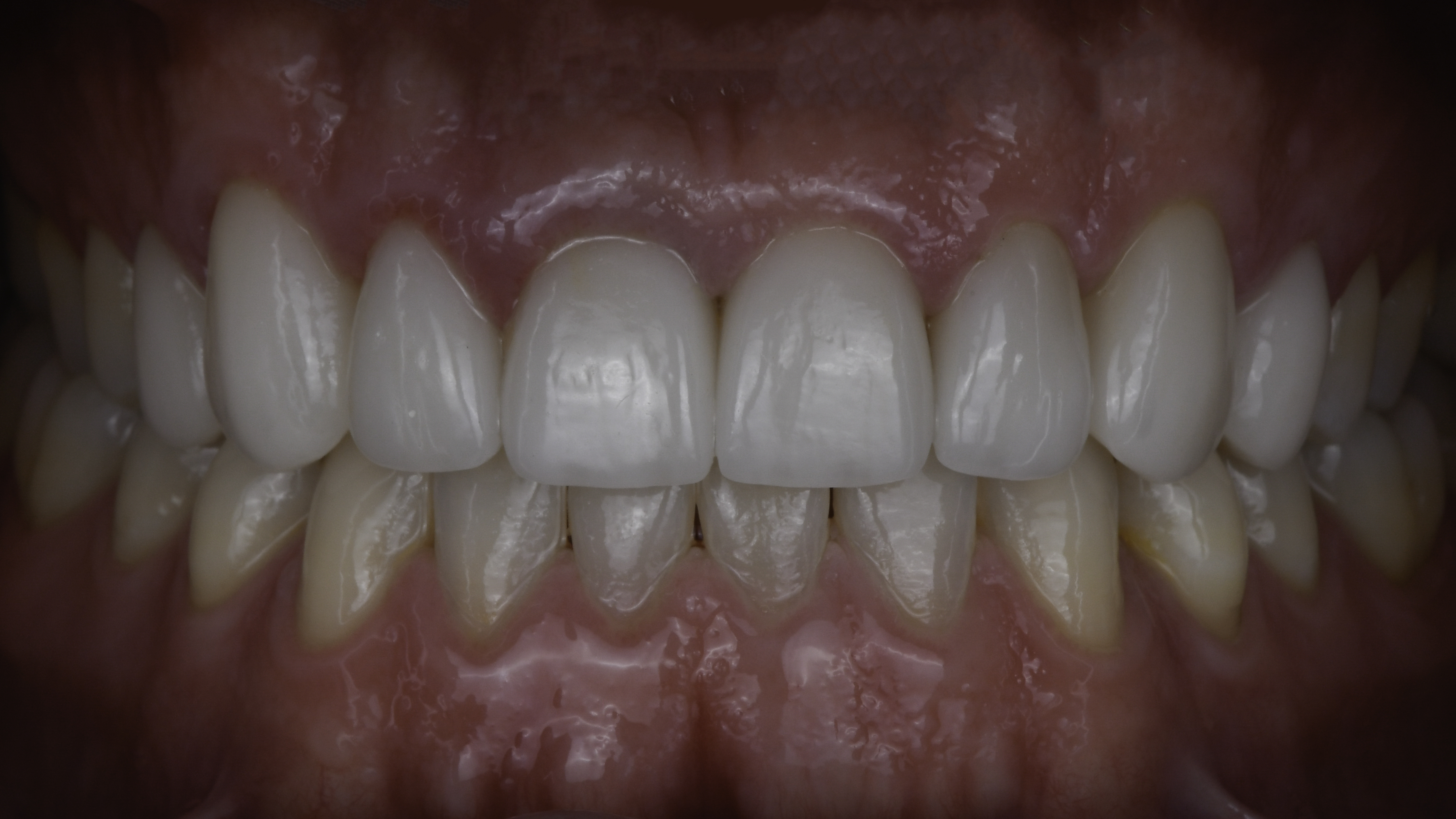 Smile makeover before and after — Smile makeover transforms shape, shade, and alignment, treated by Dr. Kambez Shukoor in Washington, DC — after treatment