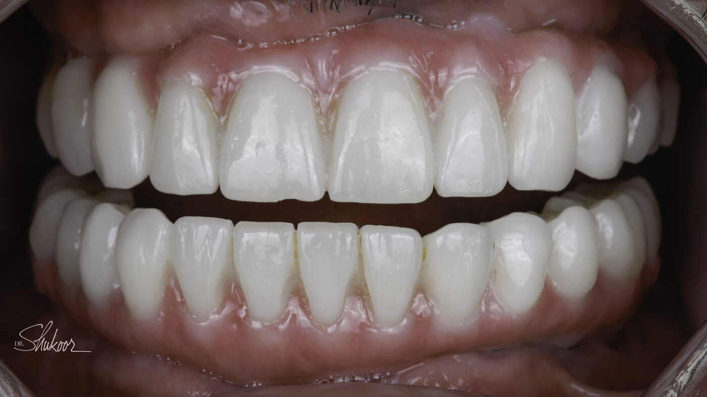 Full-Arch Implants case — Worn, discolored dentition restored with full-arch implants, treated by Dr. Kambez Shukoor in Washington, DC — after treatment