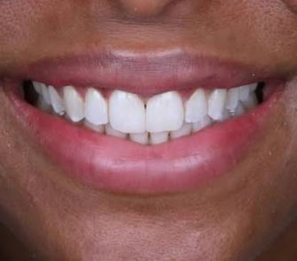 Gap Closure before and after result — Spacing between the upper front teeth closed with veneers, treated by Dr. Kambez Shukoor in Washington, DC — after treatment