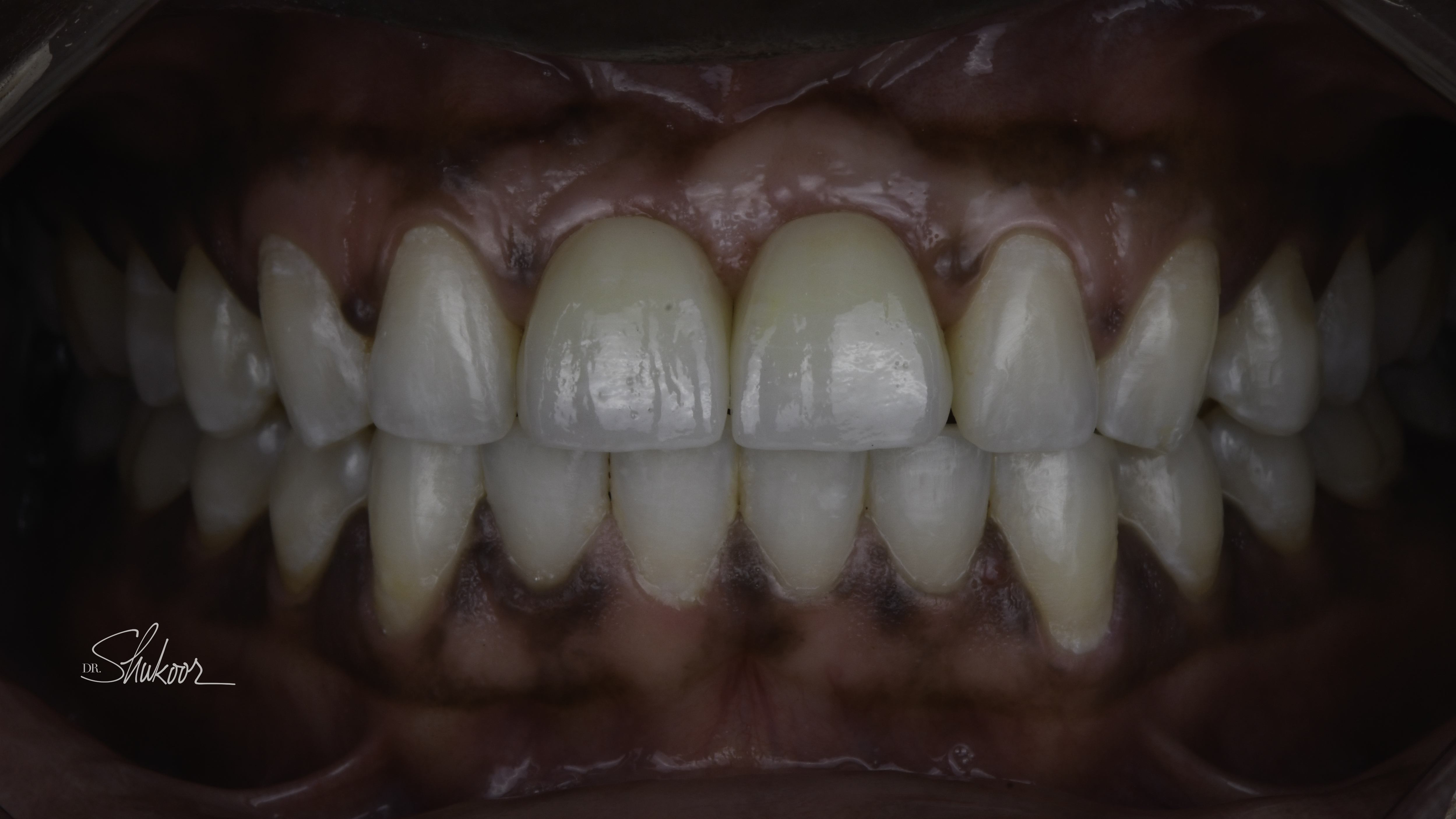Retracted view — Full-arch implant before and after, Worn, discolored front teeth restored with implant crowns, Washington, DC — after treatment
