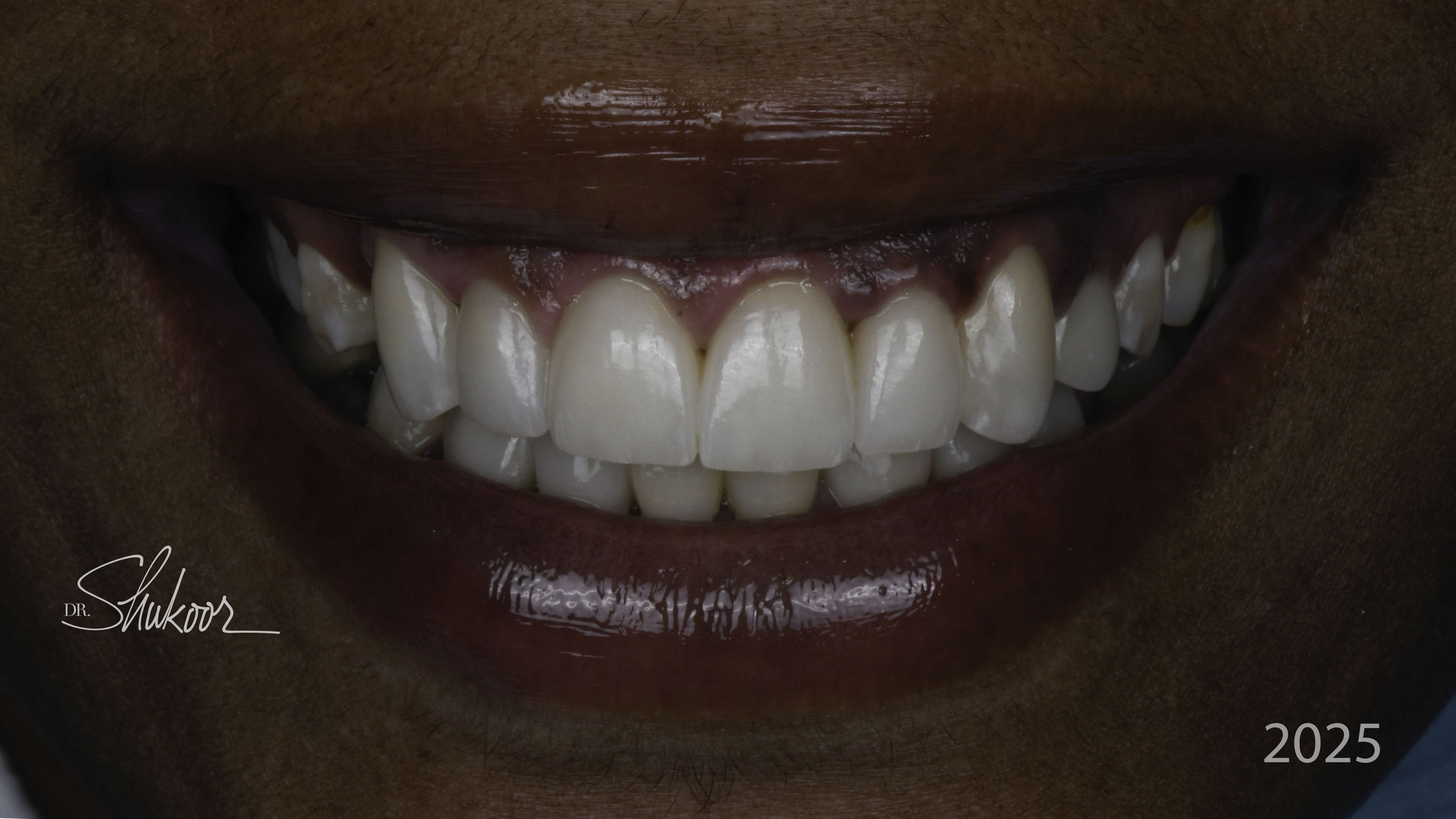 Smile makeover before and after — Complete smile makeover for a brighter, balanced smile, treated by Dr. Kambez Shukoor in Washington, DC — after treatment