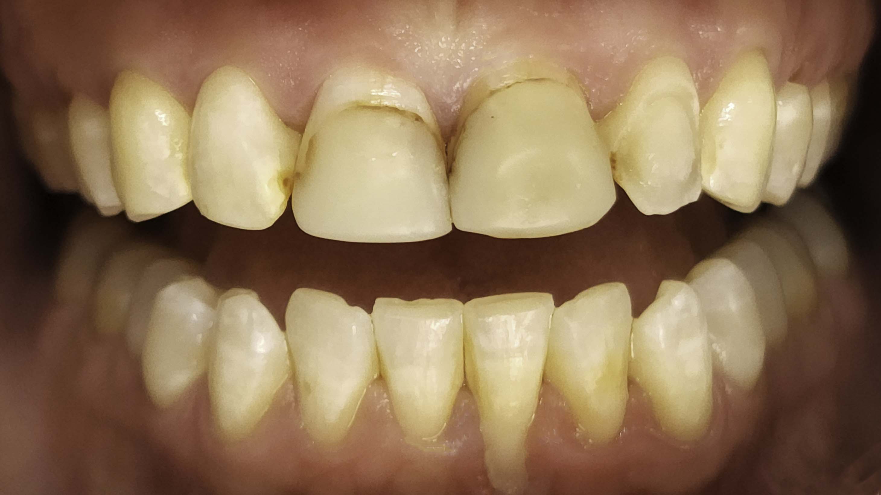Retracted view — porcelain veneers before and after, Stained, Chipped Teeth Transformed With Porcelain Veneers, Washington, DC — before treatment