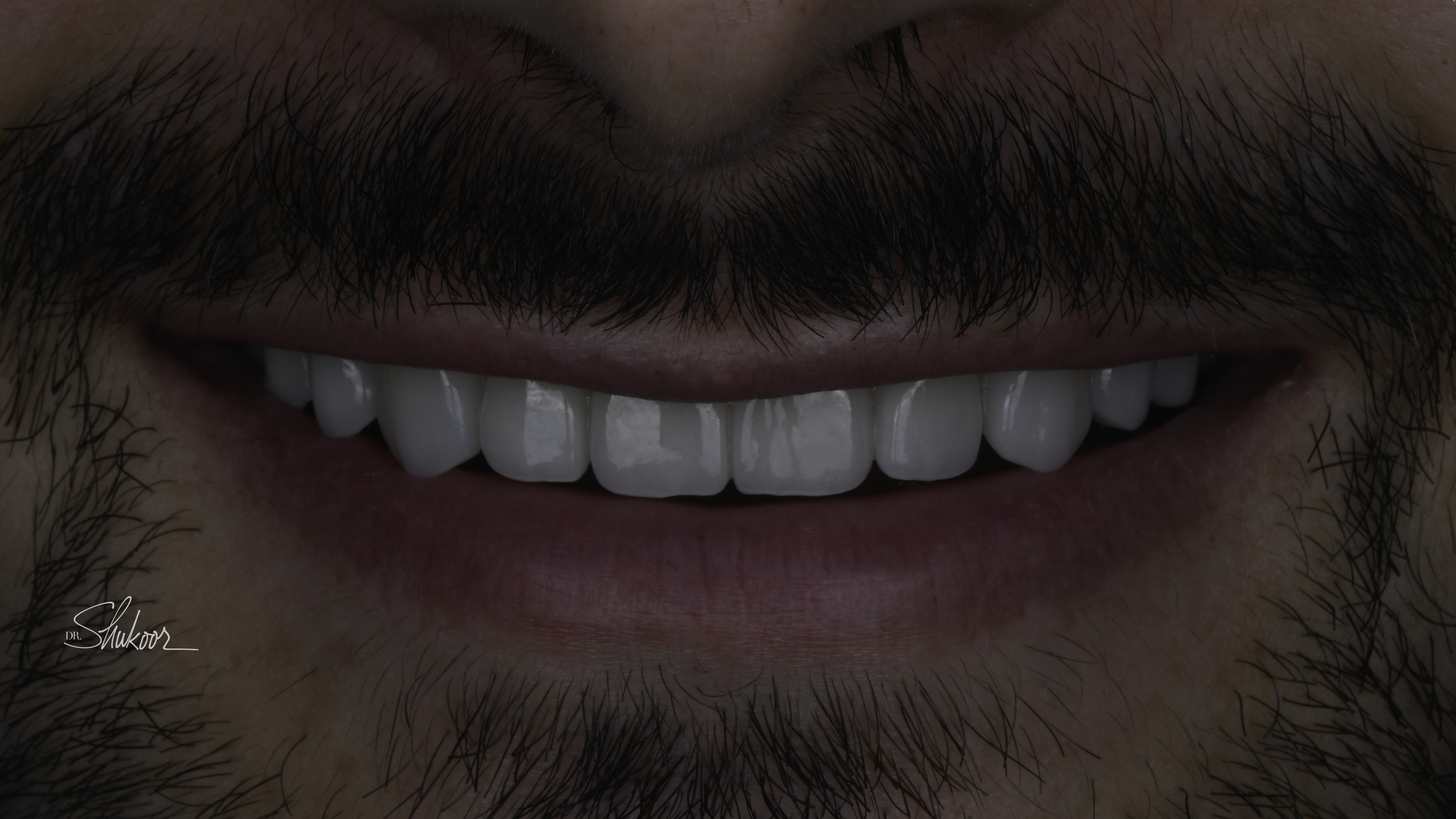 Porcelain veneers before and after — Worn & Uneven Front Teeth Rebuilt With Porcelain Veneers, treated by Dr. Kambez Shukoor in Washington, DC — after treatment