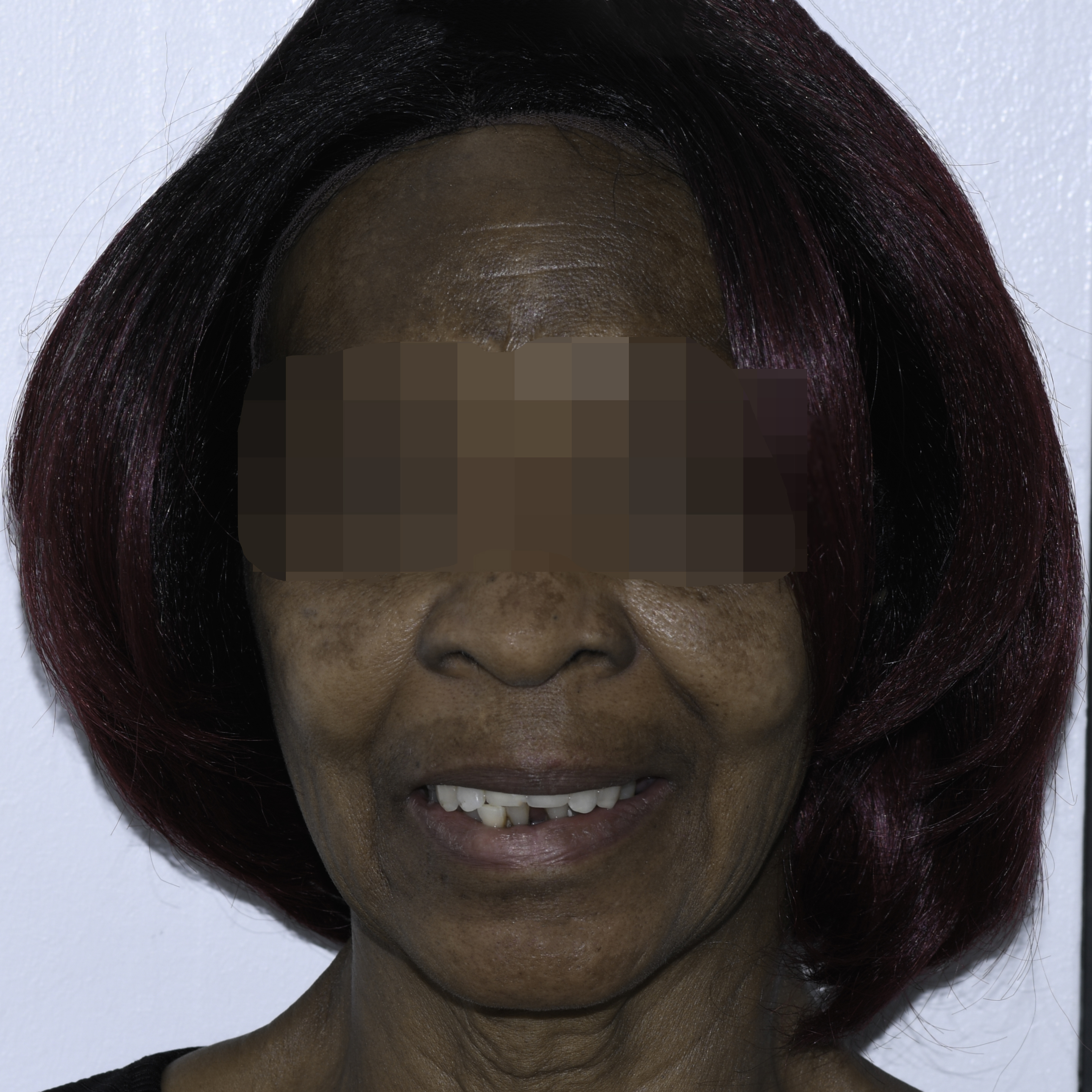 Full-arch implant before and after — Failing upper teeth replaced with a fixed implant-supported arch, treated by Dr. Kambez Shukoor in Washington, DC — before treatment