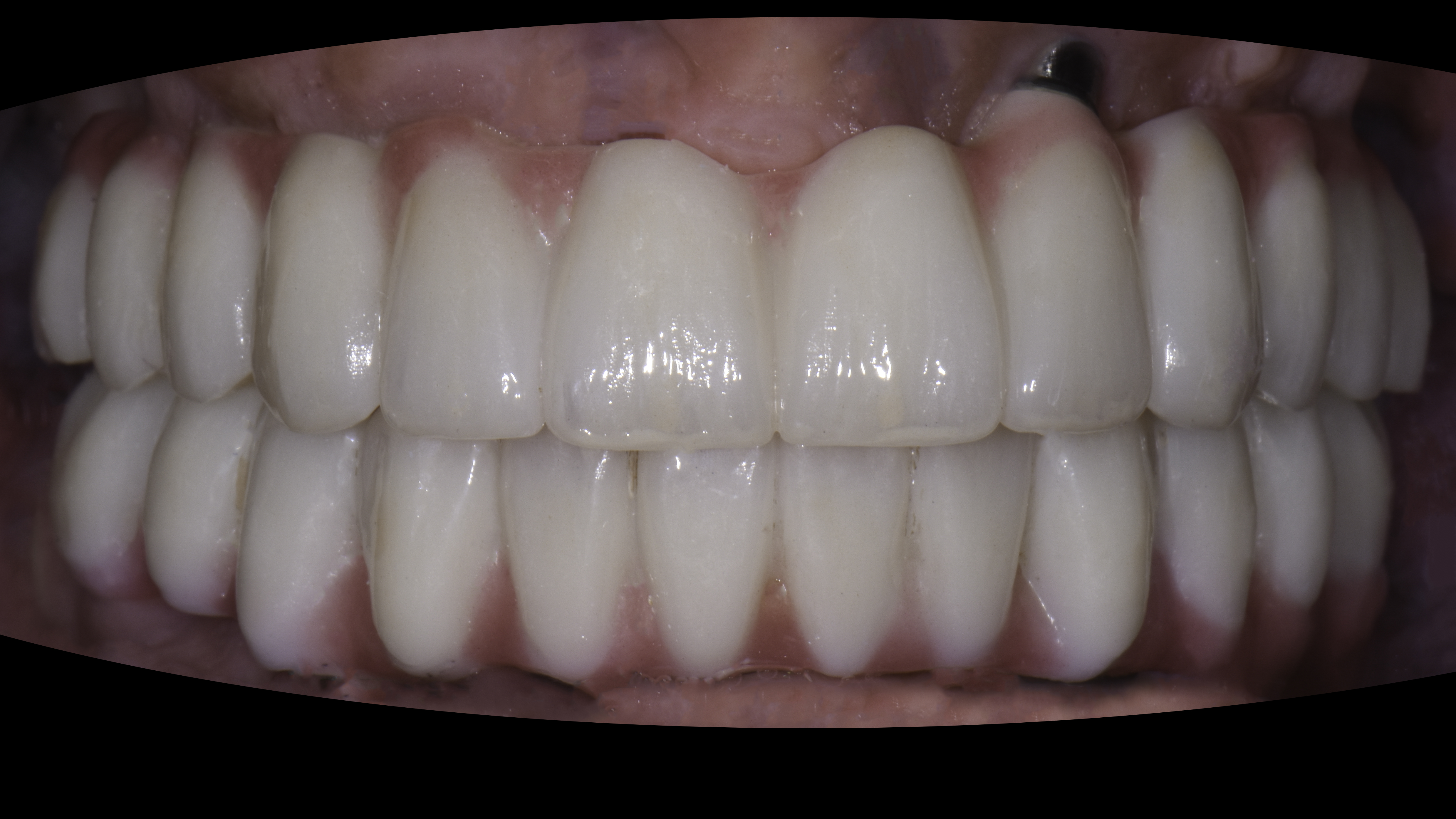 Retracted view — Full-arch implant before and after, Failing upper teeth replaced with a fixed implant-supported arch, Washington, DC — after treatment
