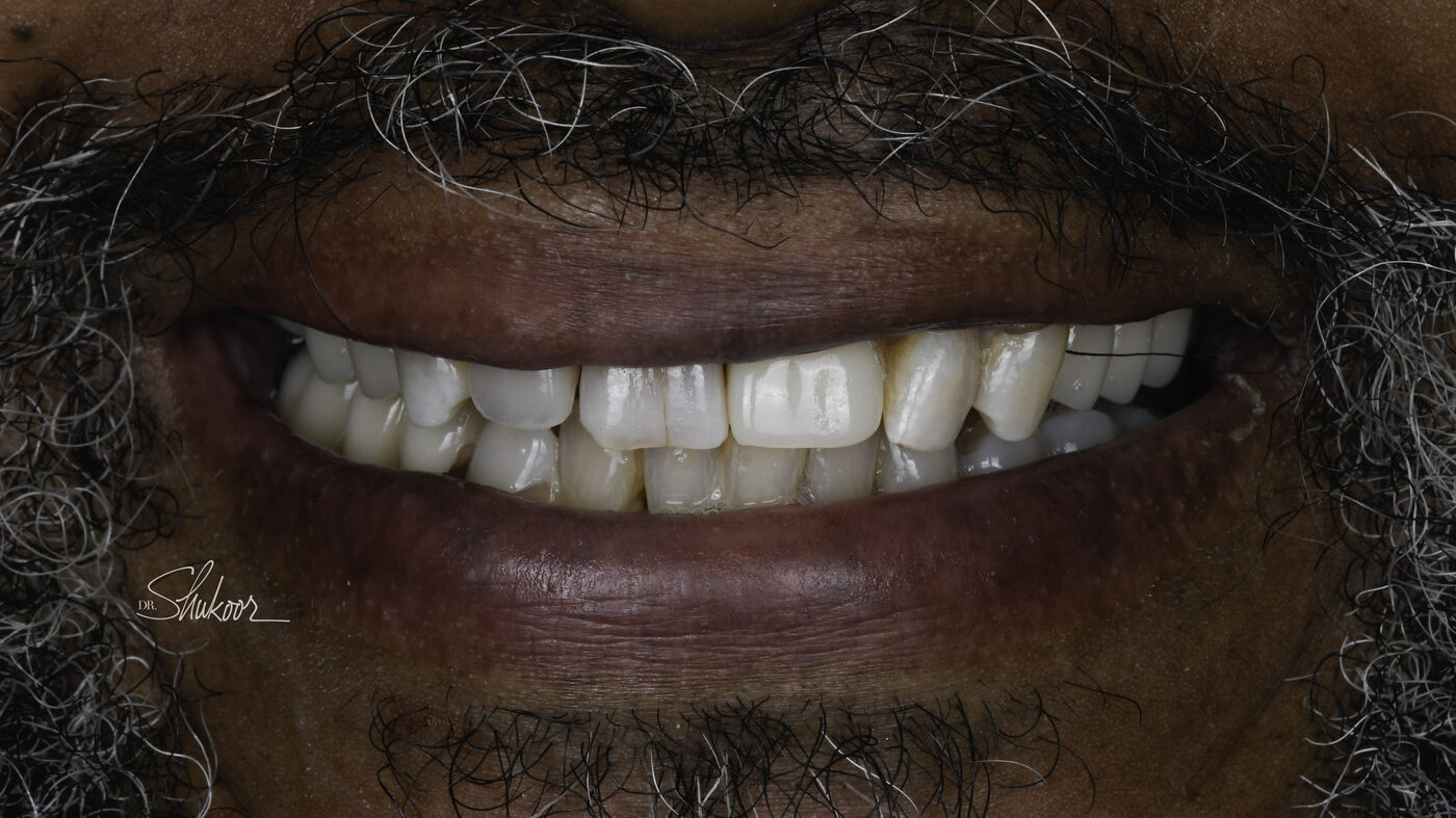 Dental Flipper case — Missing front tooth replaced immediately with a dental flipper, treated by Dr. Kambez Shukoor in Washington, DC — after treatment