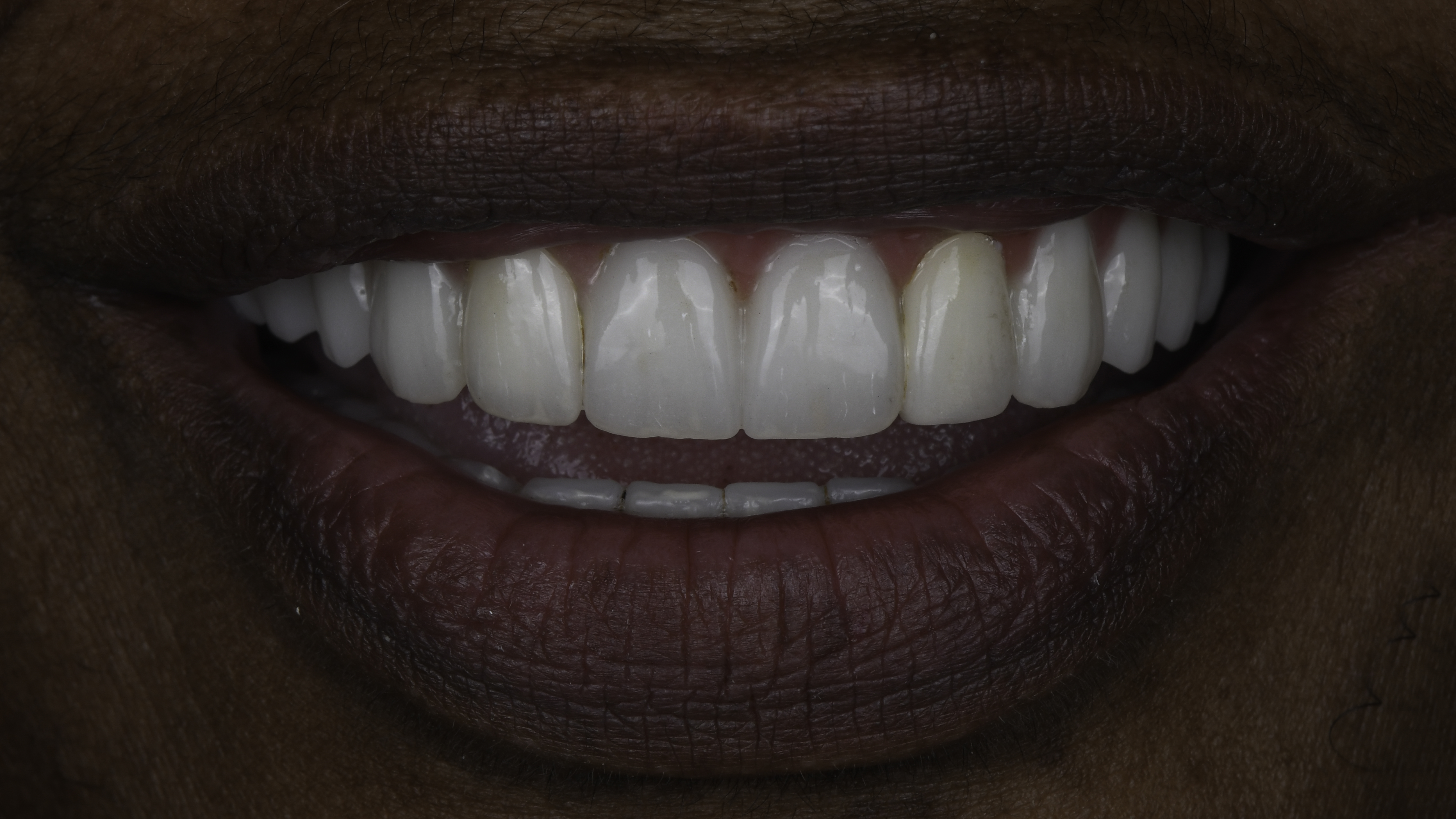 Close-up view — Full-arch implant before and after, Failing dentition replaced with fixed full-arch implant teeth, Washington, DC — after treatment
