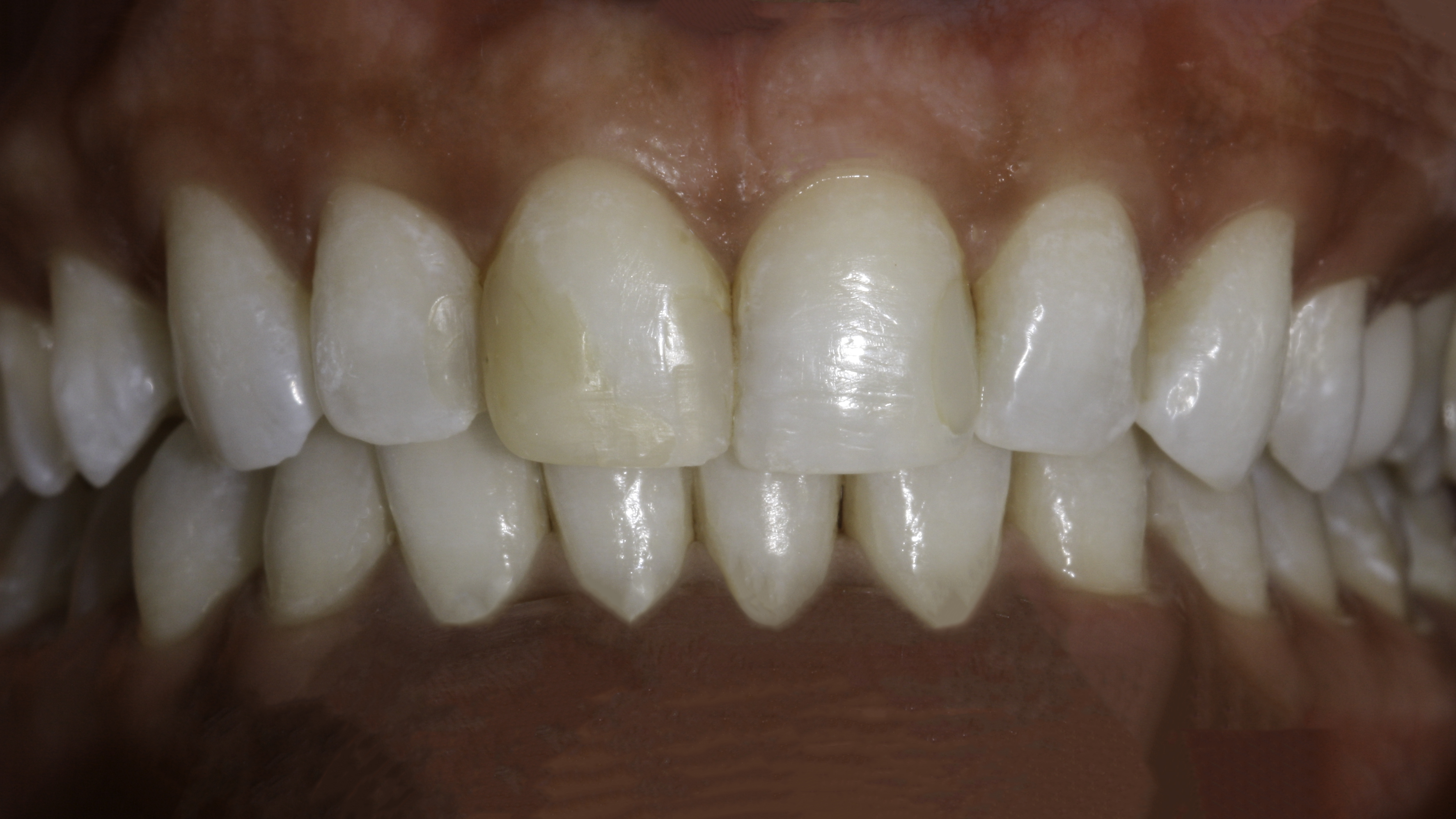 Porcelain veneers before and after — Gap Between Front Teeth Closed With Porcelain Veneers, treated by Dr. Kambez Shukoor in Washington, DC — before treatment