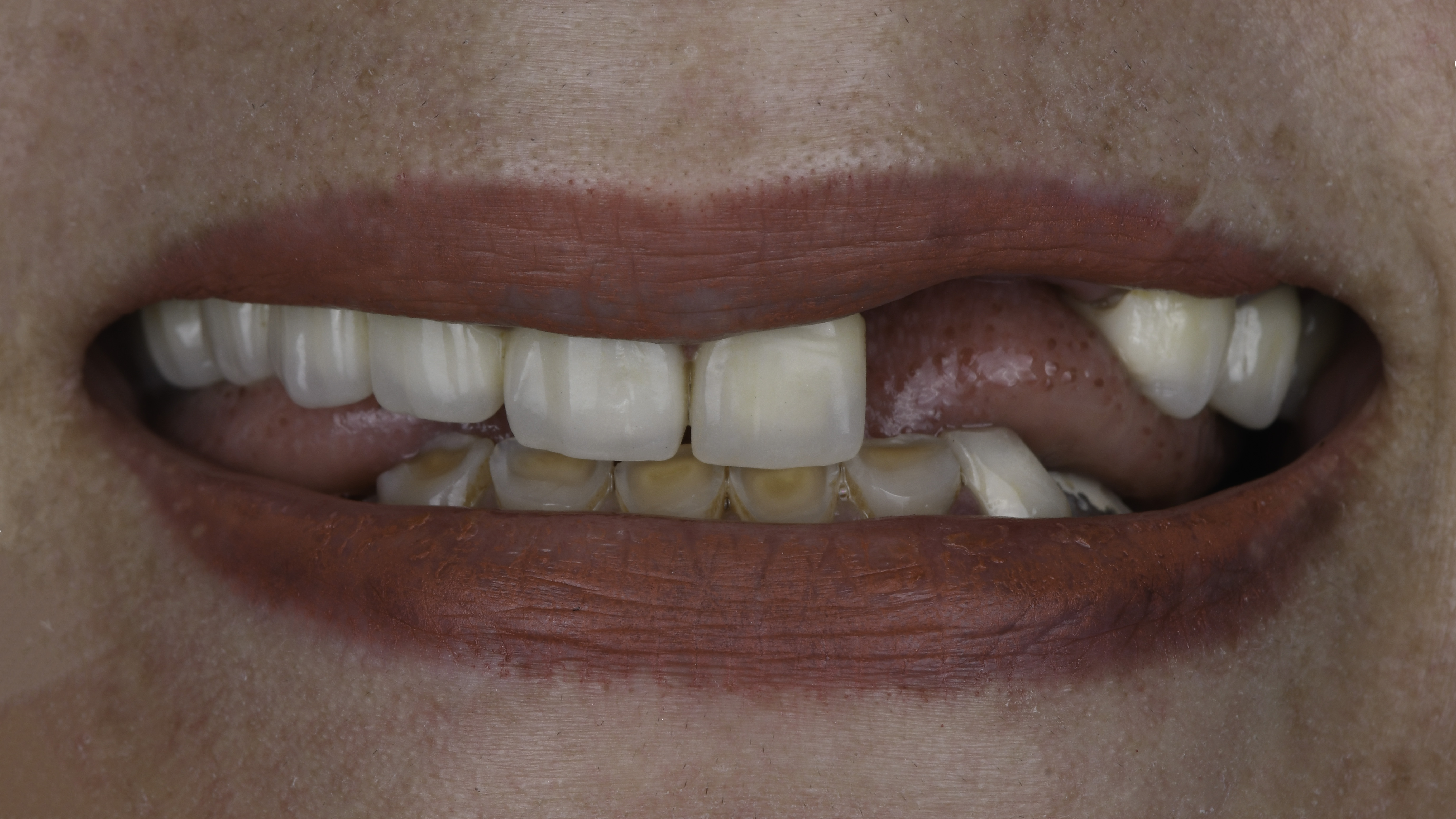 Close-up view — Single tooth implant before and after, Missing tooth replaced with a single dental implant and crown, Washington, DC — before treatment