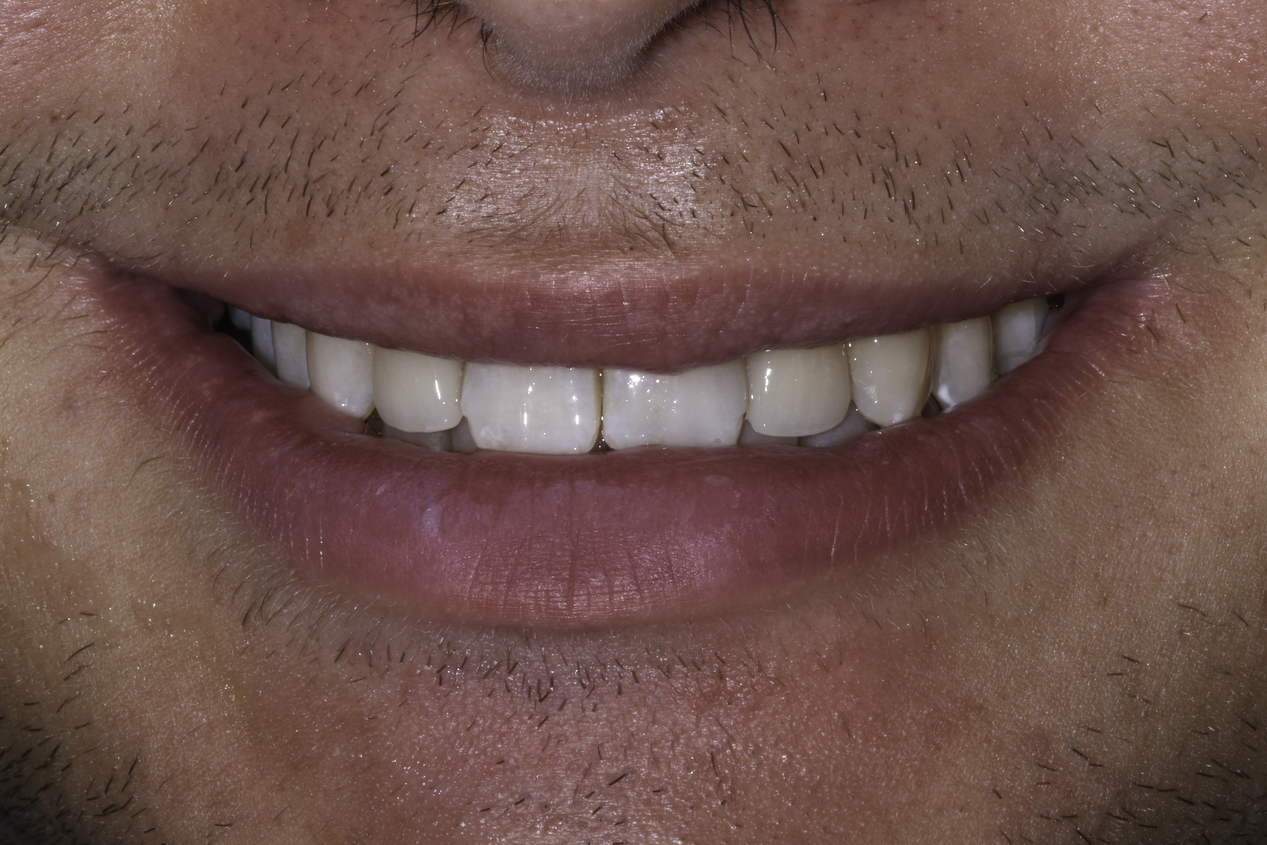 Porcelain veneers before and after — Small, uneven front teeth rebuilt with porcelain veneers, treated by Dr. Kambez Shukoor in Washington, DC — after treatment