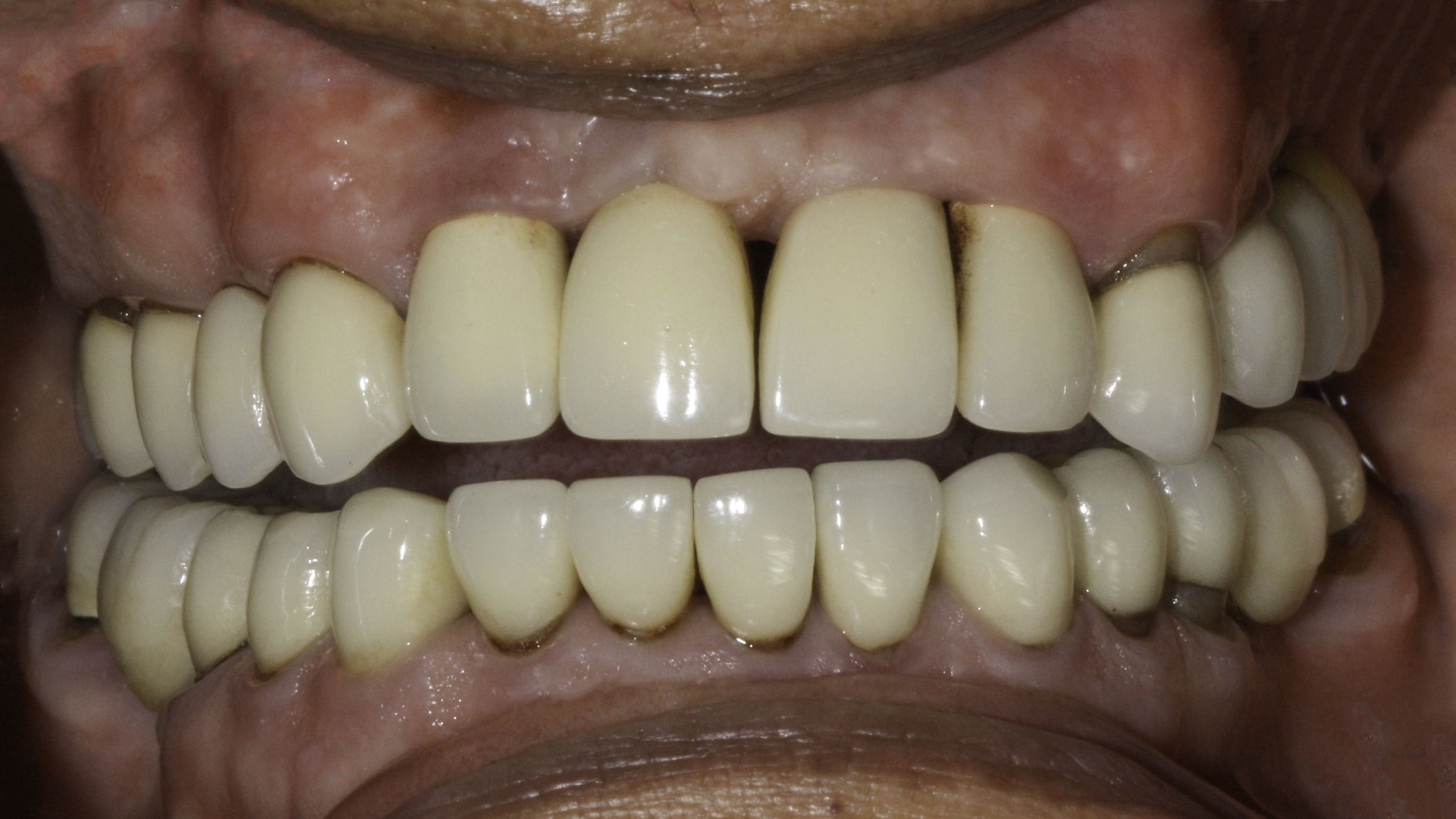 Close-up view — Smile makeover before and after, Worn, mismatched restorations rebuilt in a full-mouth rehabilitation, Washington, DC — before treatment