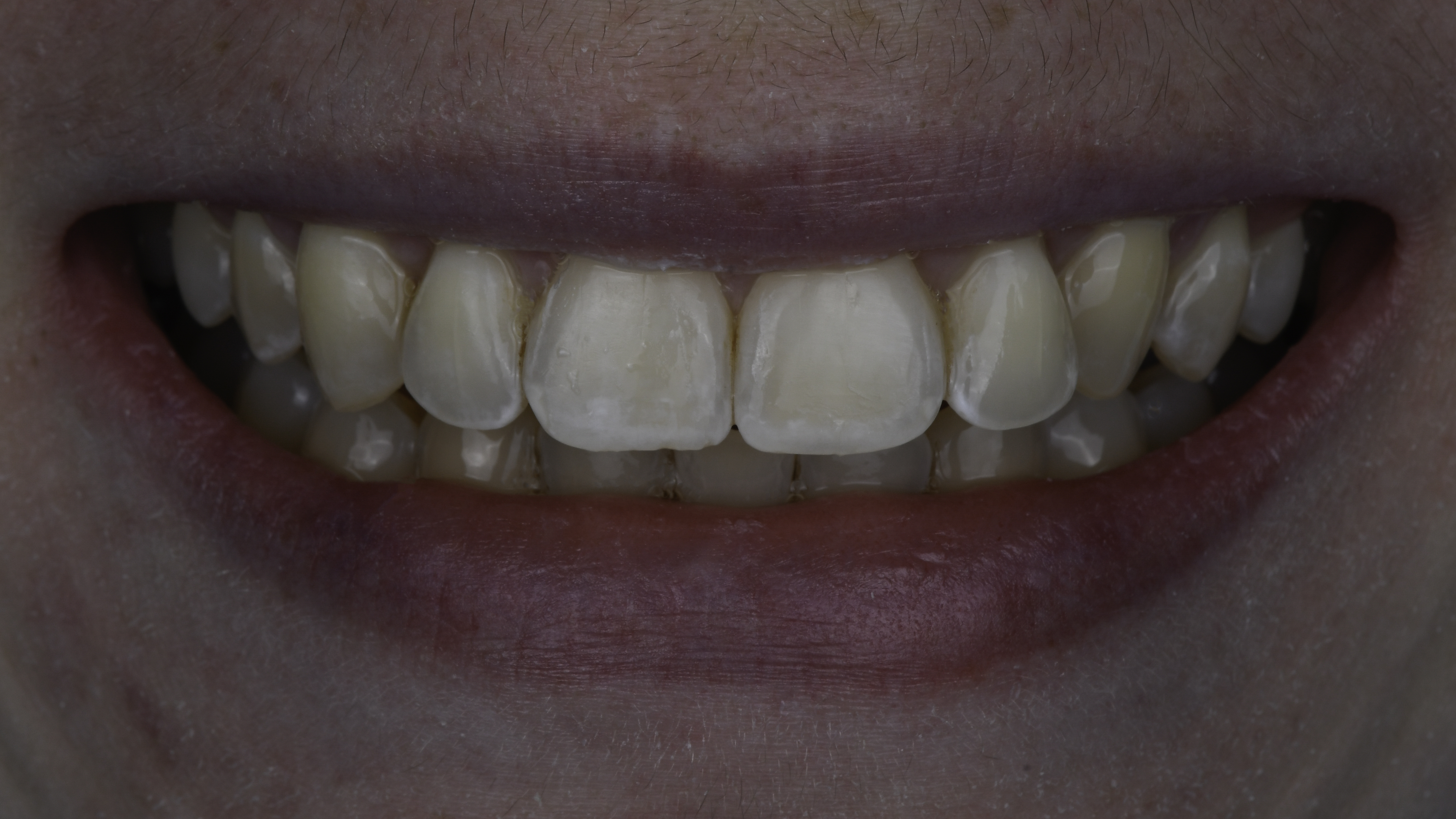 Clear aligners before and after — Overlapping front teeth straightened with clear aligner therapy, treated by Dr. Kambez Shukoor in Washington, DC — after treatment