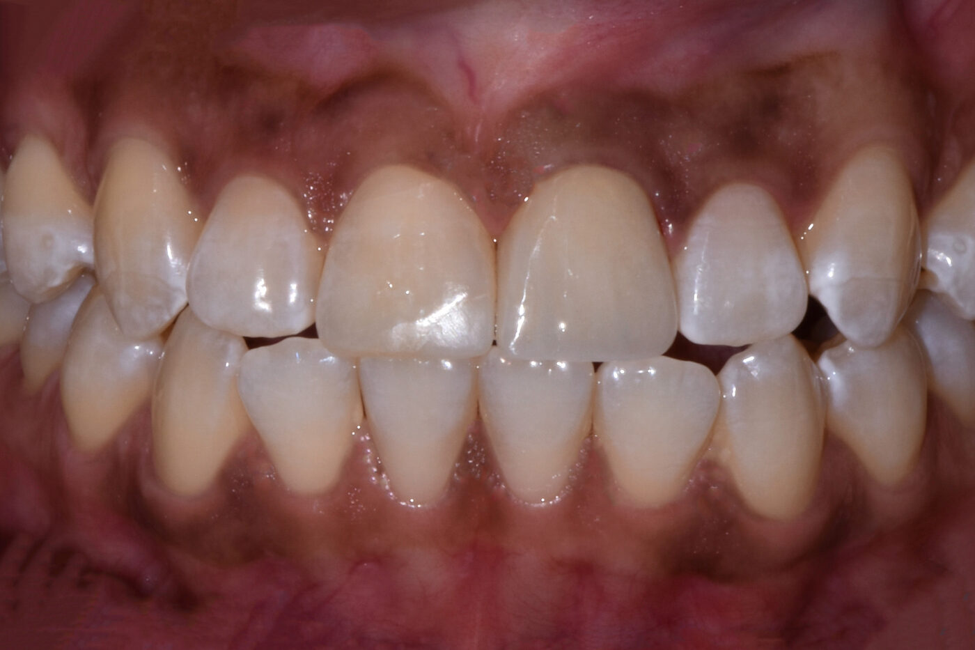 Dental Bonding case — Chipped and worn upper front teeth rebuilt with composite bonding, treated by Dr. Kambez Shukoor in Washington, DC — after treatment